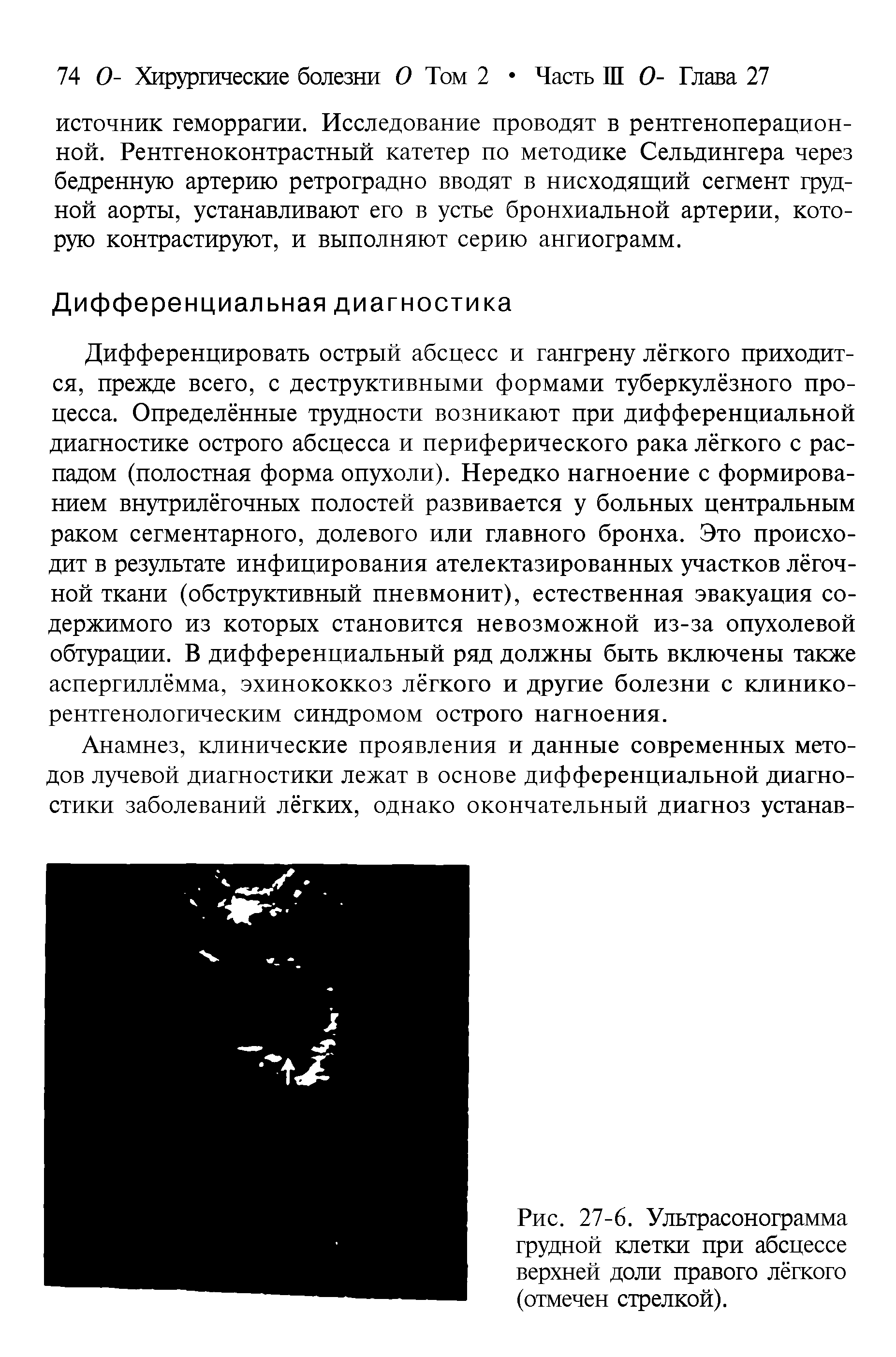 Рис. 27-6. Ультрасонограмма грудной клетки при абсцессе верхней доли правого лёгкого (отмечен стрелкой).