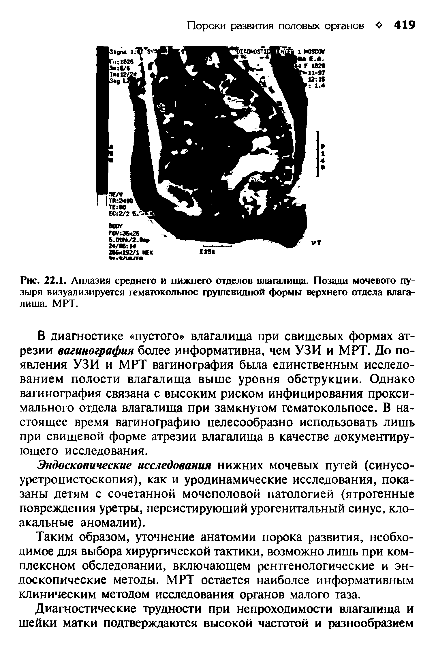 Рис. 22.1. Аплазия среднего и нижнего отделов влагалища. Позади мочевого пузыря визуализируется гематокольпос грушевидной формы верхнего отдела влагалища. МРТ.