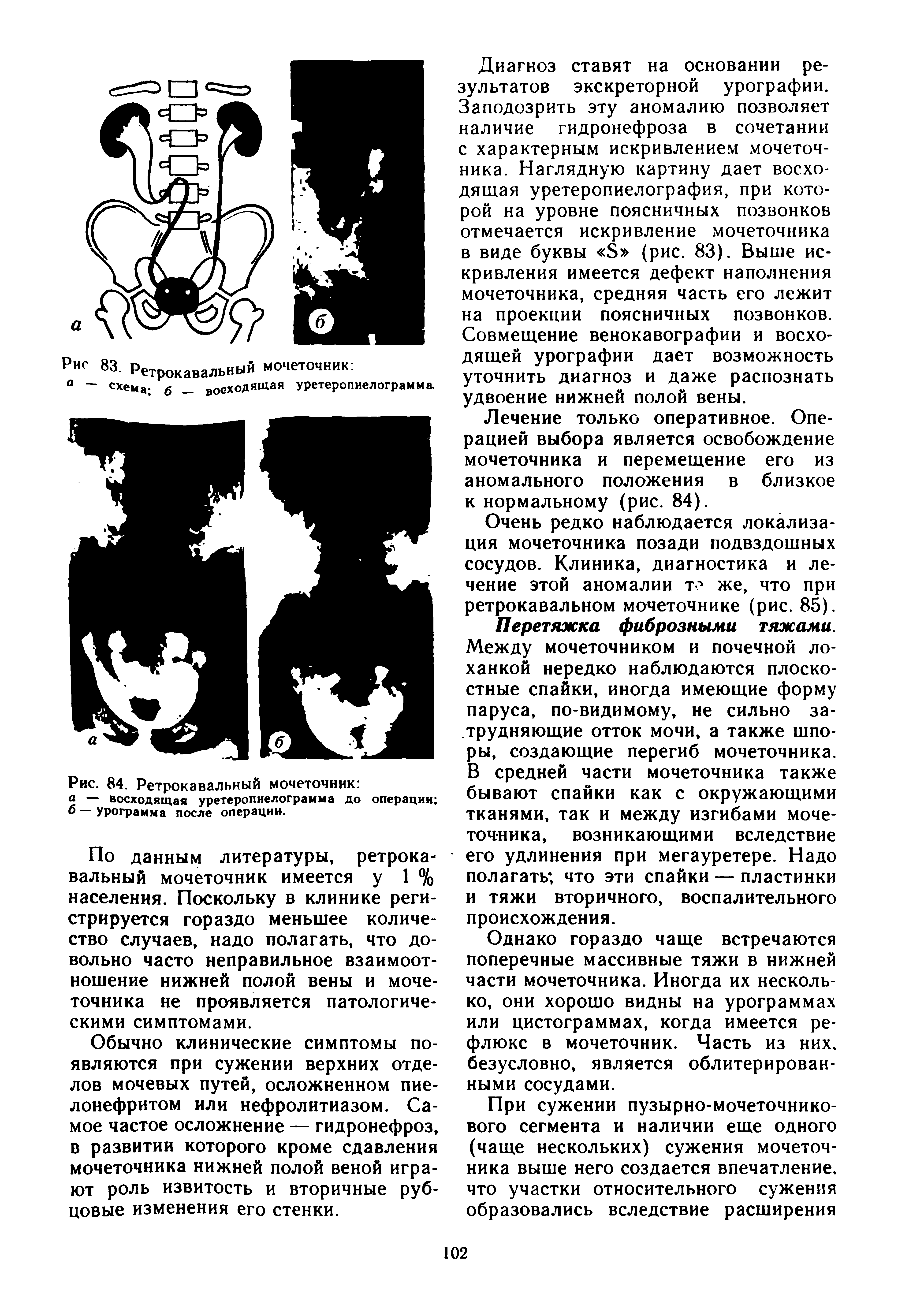 Рис. 84. Ретрокавальный мочеточник а — восходящая уретеропиелограмма до операции б — урограмма после операции.