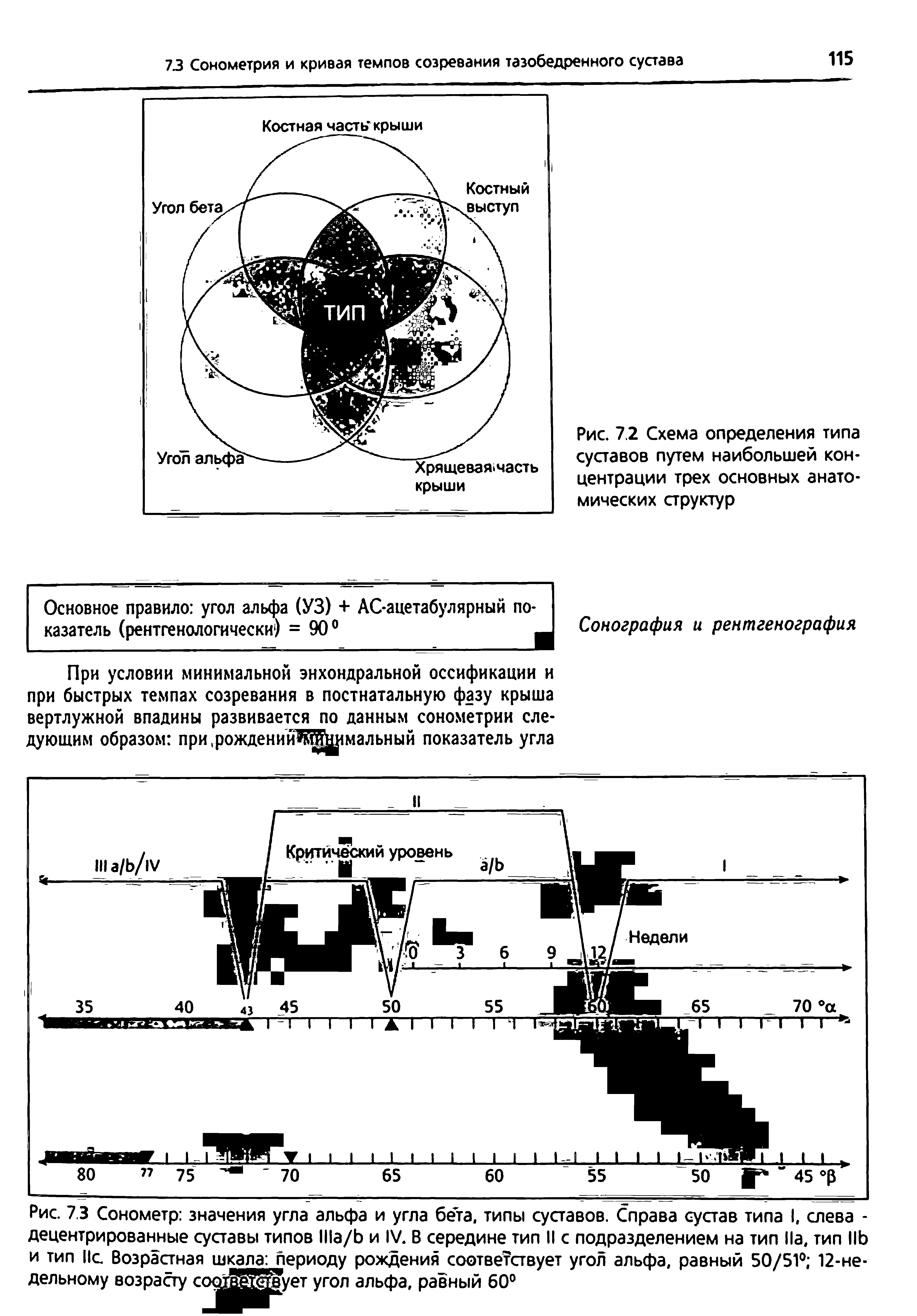 Рис. 7.3 Сонометр значения угла альфа и угла бета, типы суставов. Справа сустав типа I, слева -децентрированные суставы типов / и IV. В середине тип II с подразделением на тип Па, тип ПЬ и тип Не Возрастная шкала периоду рождения соответствует угол альфа, равный 50/51° 12-недельному возрасту сор...