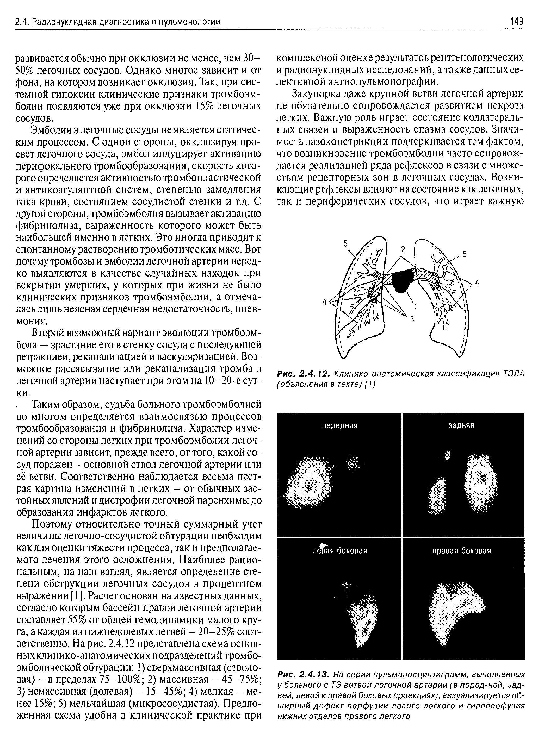 Рис. 2.4.12. Клинико-анатомическая классификация ТЭЛА (объяснения в текте) [1]...