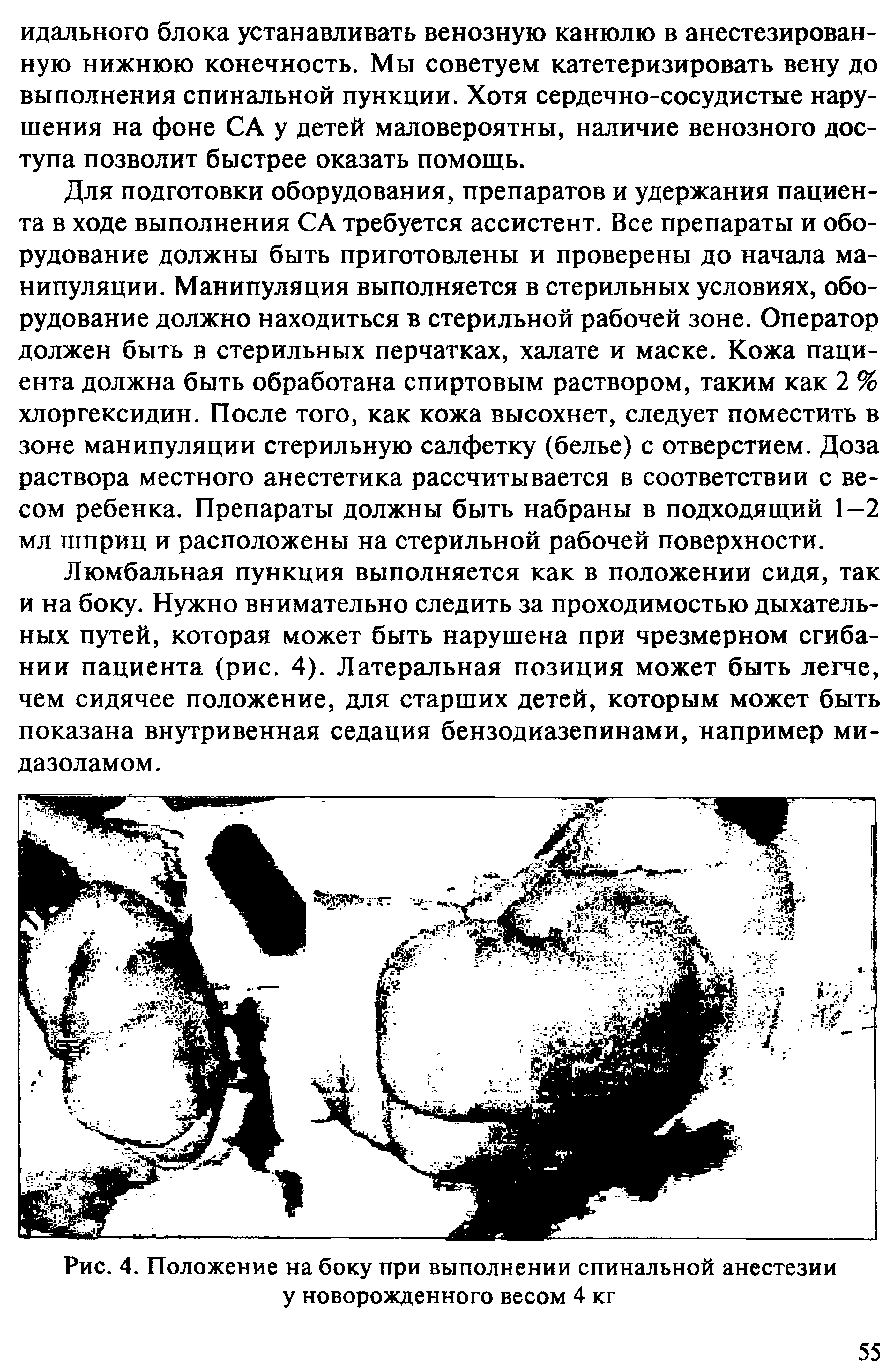 Рис. 4. Положение на боку при выполнении спинальной анестезии у новорожденного весом 4 кг...