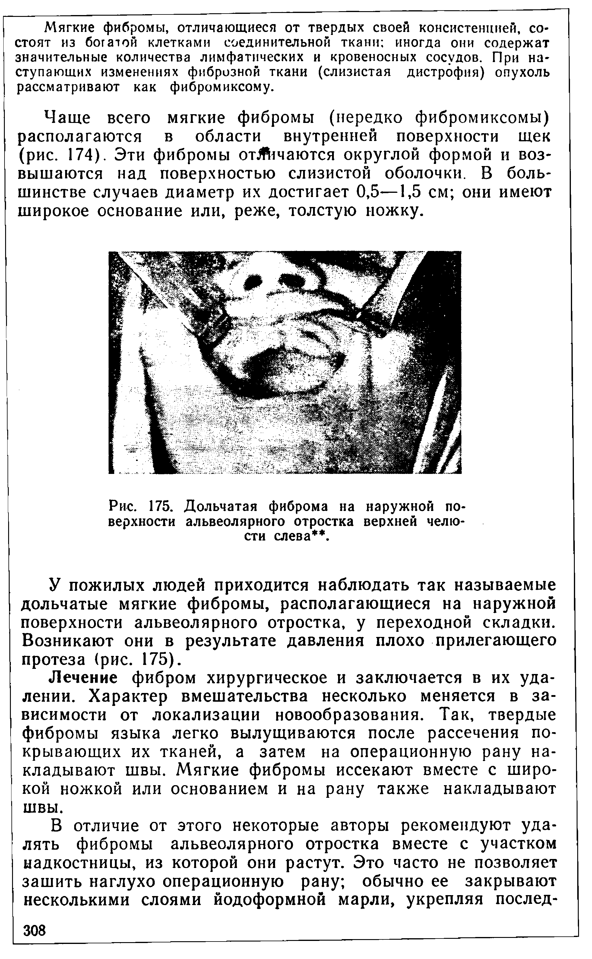 Рис. 175. Дольчатая фиброма на наружной поверхности альвеолярного отростка верхней челюсти слева. ...