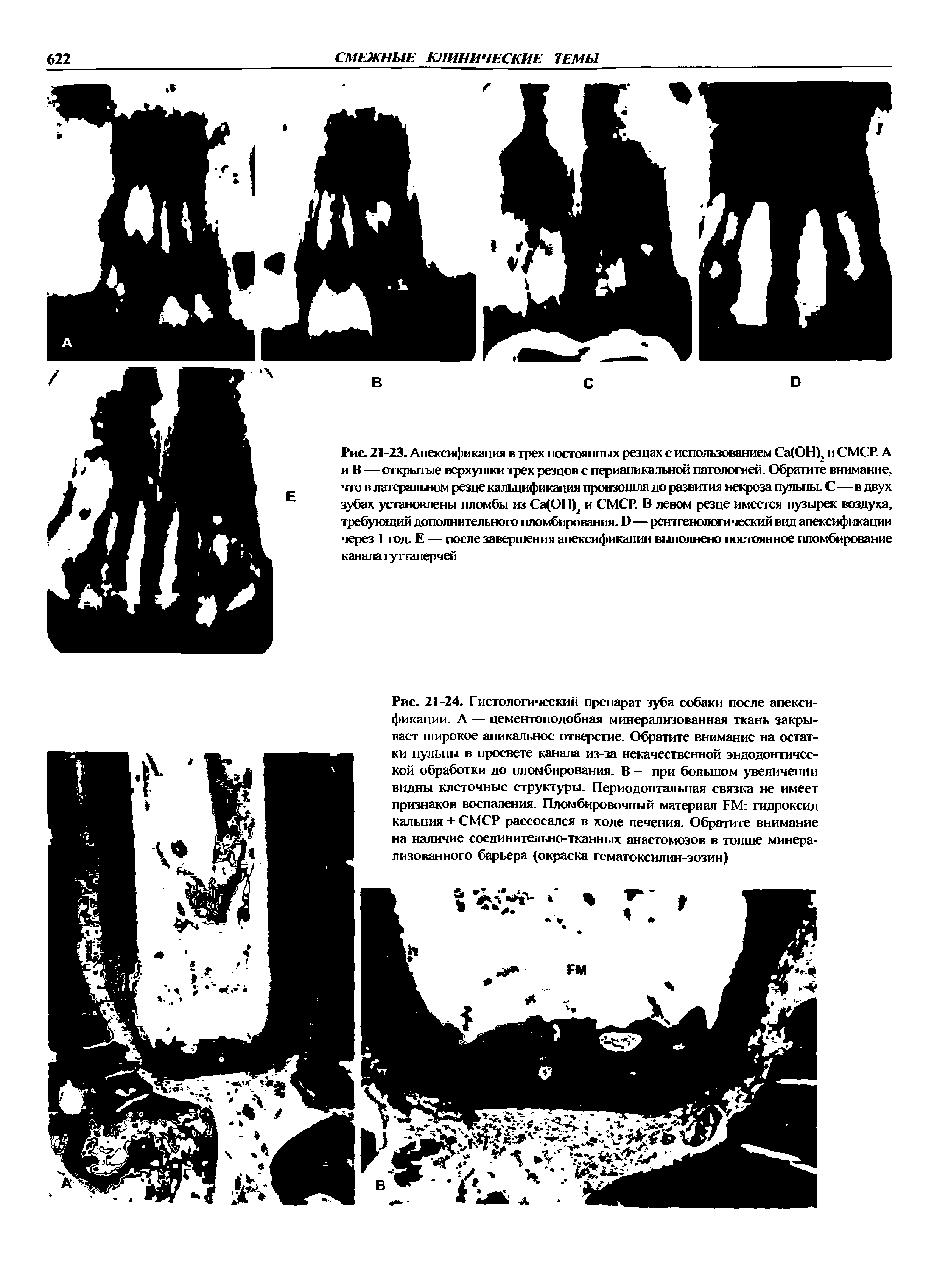 Рис. 21-24. Гистологический препарат зуба собаки после апексификации. А — цементоподобная минерализованная ткань закрывает широкое апикальное отверстие. Обратите внимание на остат-...