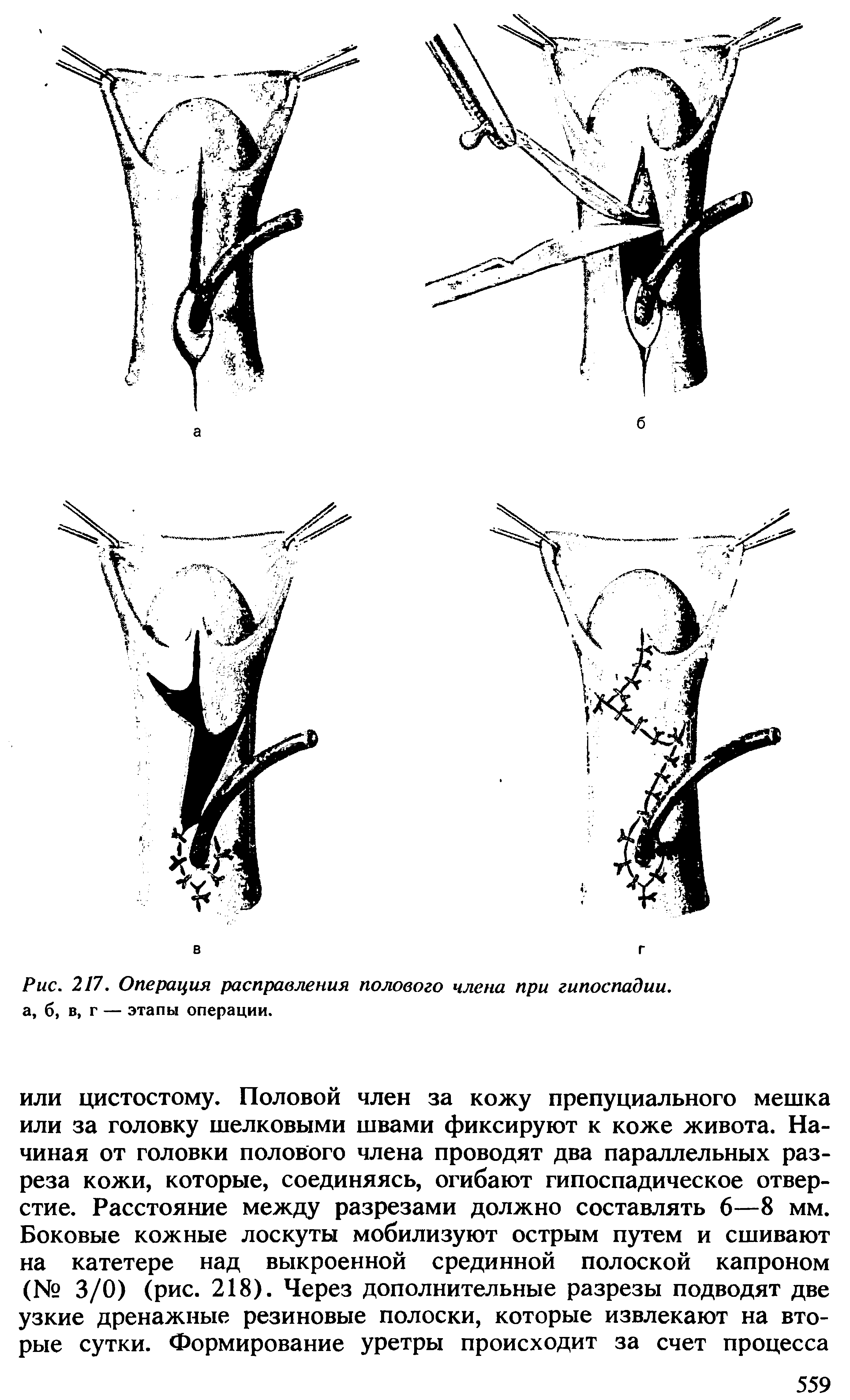 Рис. 217. Операция расправления полового члена при гипоспадии. а, б, в, г — этапы операции.
