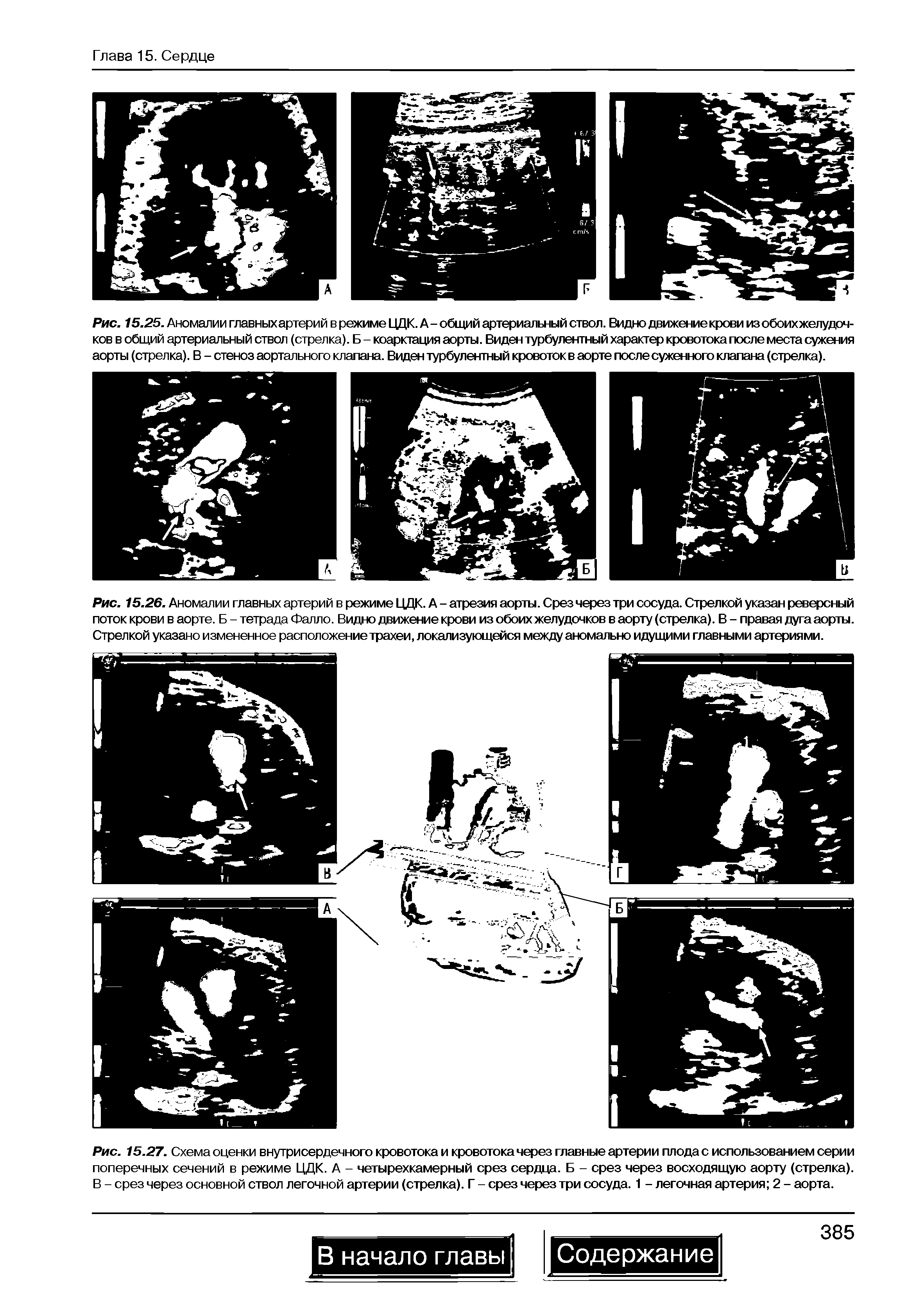 Рис. 15.25. Аномалии главных артерий в режиме ЦДК. А - общий артериальный ствол. Видно движение крови из обоихжелудоч-ков в общий артериальный ствол (стрелка). Б - коарктация аорты. Виден турбулентный характер кровотока после места сужения аорты (стрелка). В - стеноз аортального клапана. Виден турбулентный кровоток в аорте после суженного клапана (стрелка).