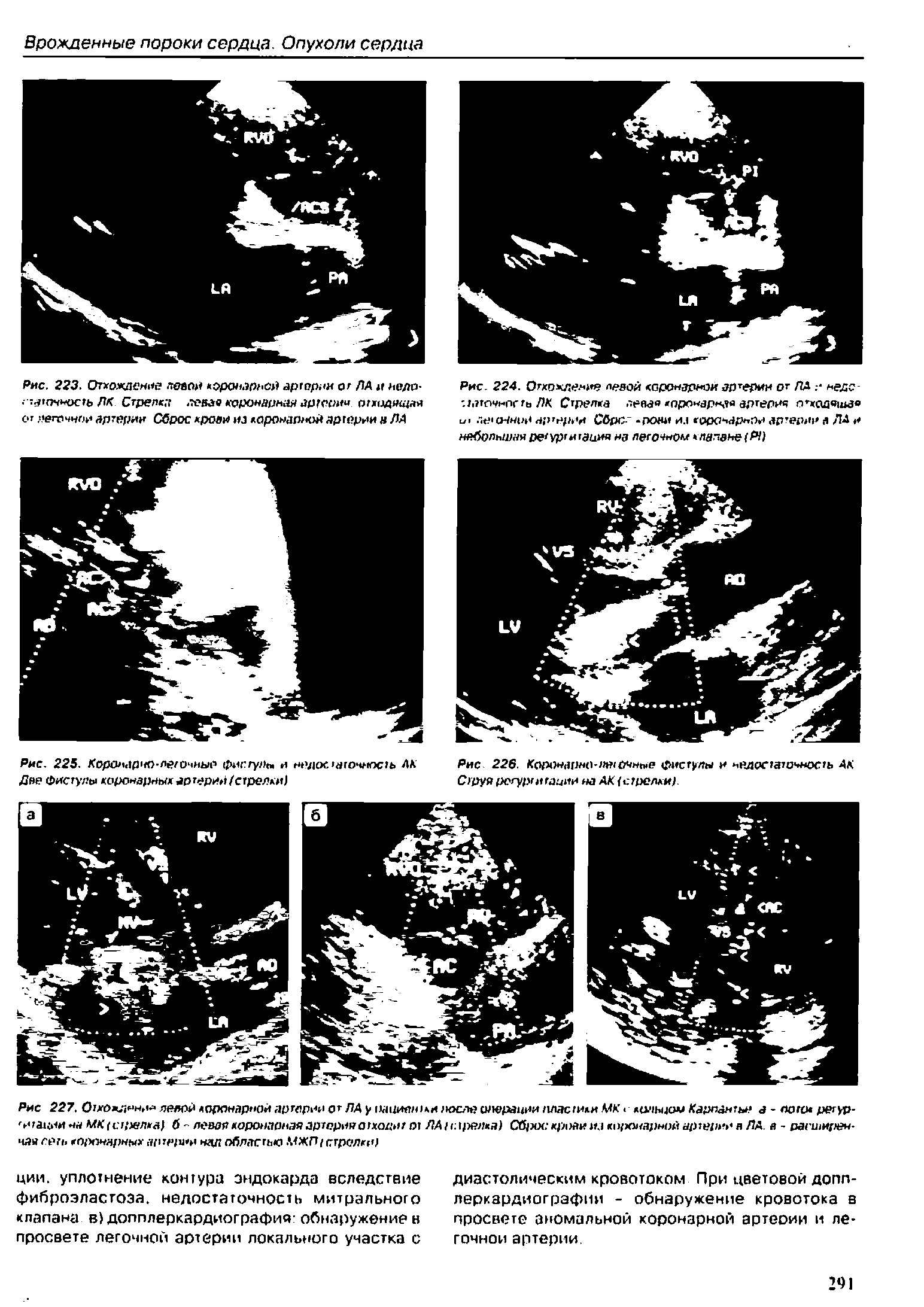 Рис. 225. Коронарно-леточиые фиг.гулы и недостаточность АК Две Фистулы коронарных артерии (стрелки ...