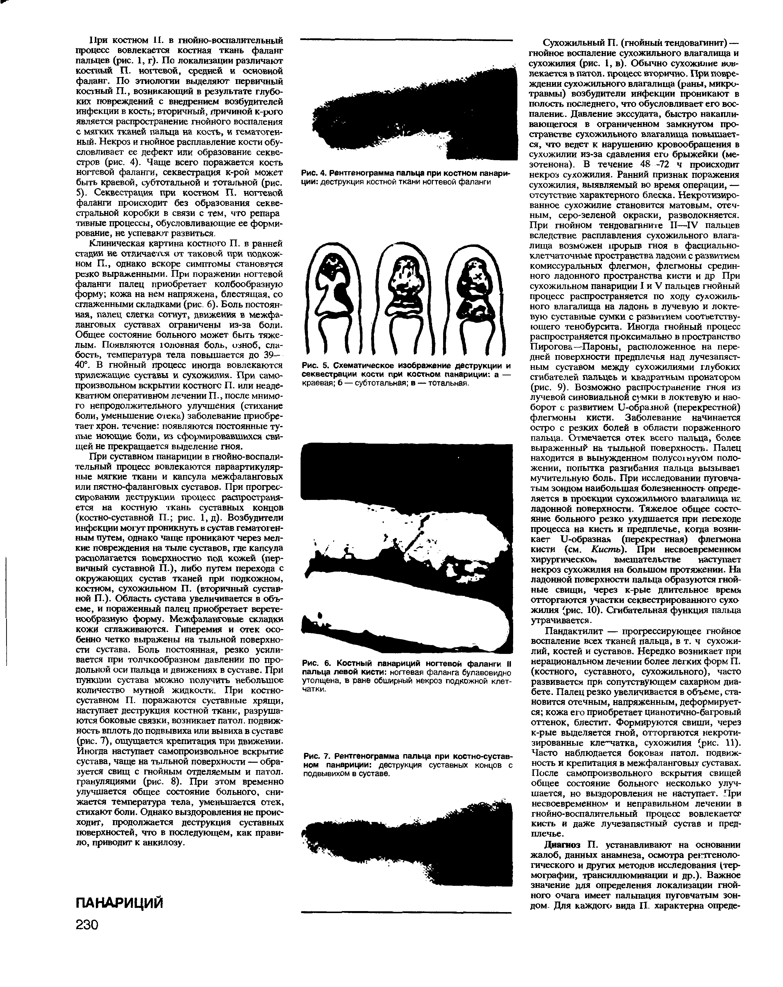 Рис. 5. Схематическое изображение деструкции и секвестрации кости при костном панариции а — краевая б — субтотальная в — тотальная.