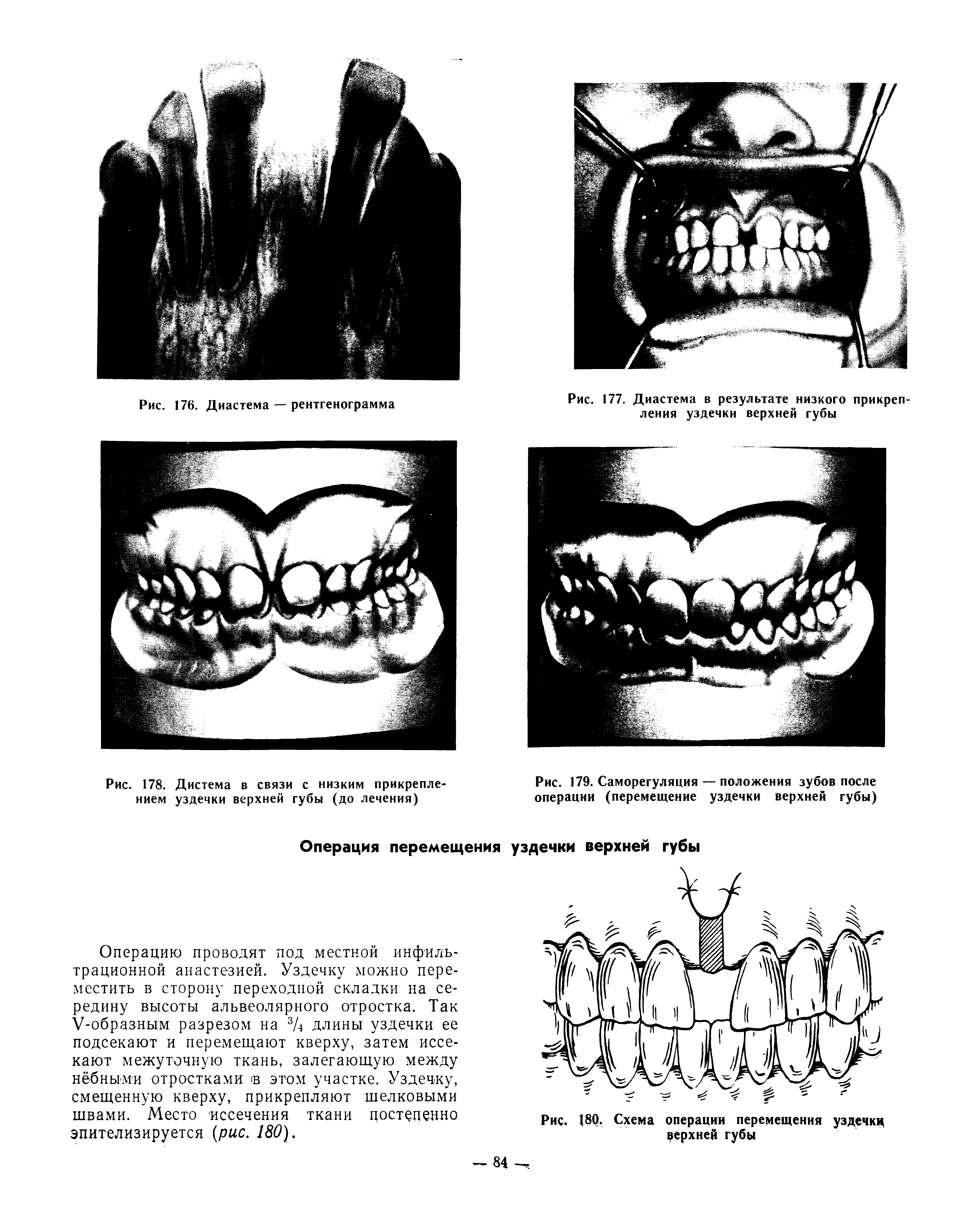 Рис. 179. Саморегуляция — положения зубов после операции (перемещение уздечки верхней губы)...