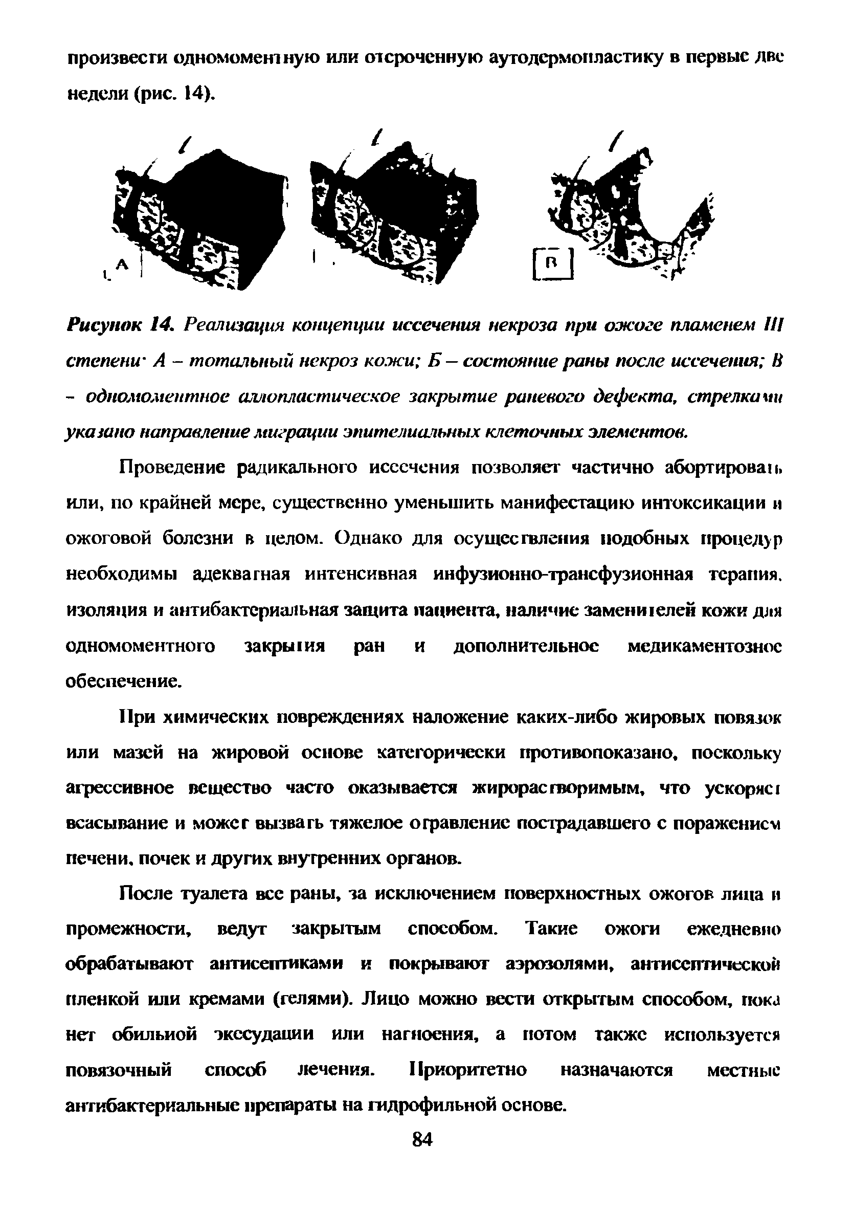 Рисунок 14. Реализация концепции иссечения некроза при ожоге пламенем III степени- А - тотальный некроз кожи Б — состояние раны после иссечения В - одномоментное аллопластическое закрытие раневого дефекта, стрелка ии указано направление миграции эпителиальных клеточных элементов.