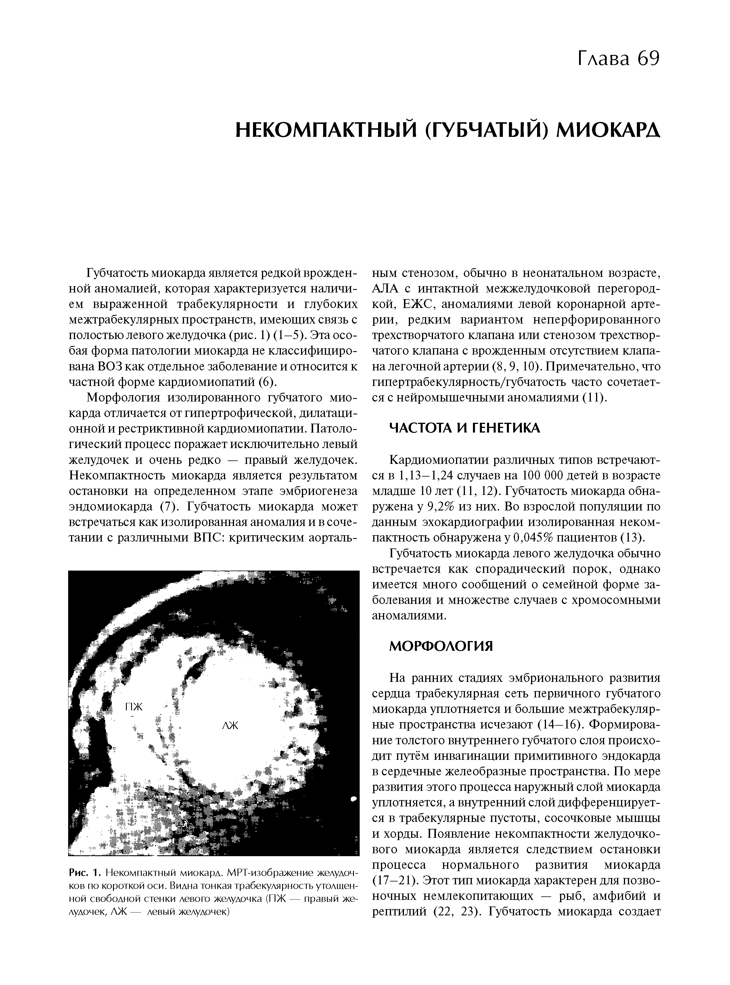 Рис. 1. Некомпактный миокард. МРТ-изображение желудочков по короткой оси. Видна тонкая трабекулярность утолщенной свободной стенки левого желудочка (ПЖ — правый желудочек, АЖ — левый желудочек)...