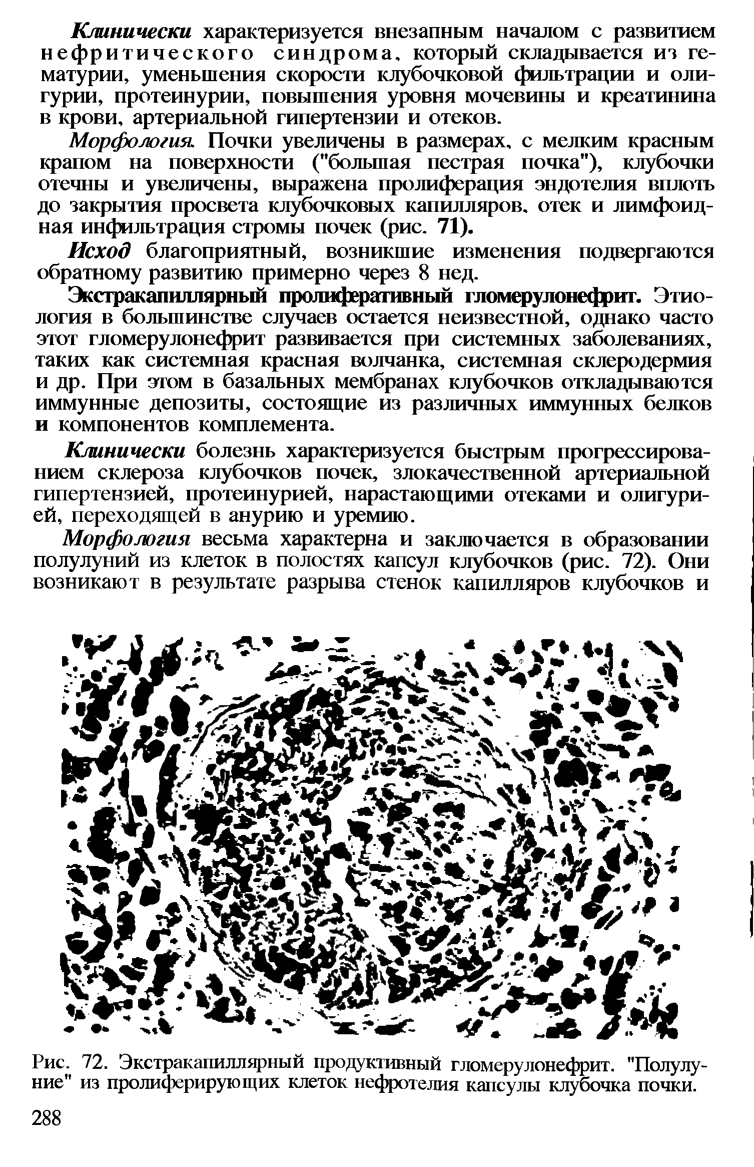 Рис. 72. Экстракапиллярный продуктивный гломерулонефрит. "Полулуние" из пролиферирующих клеток нефротелия капсулы клубочка почки.