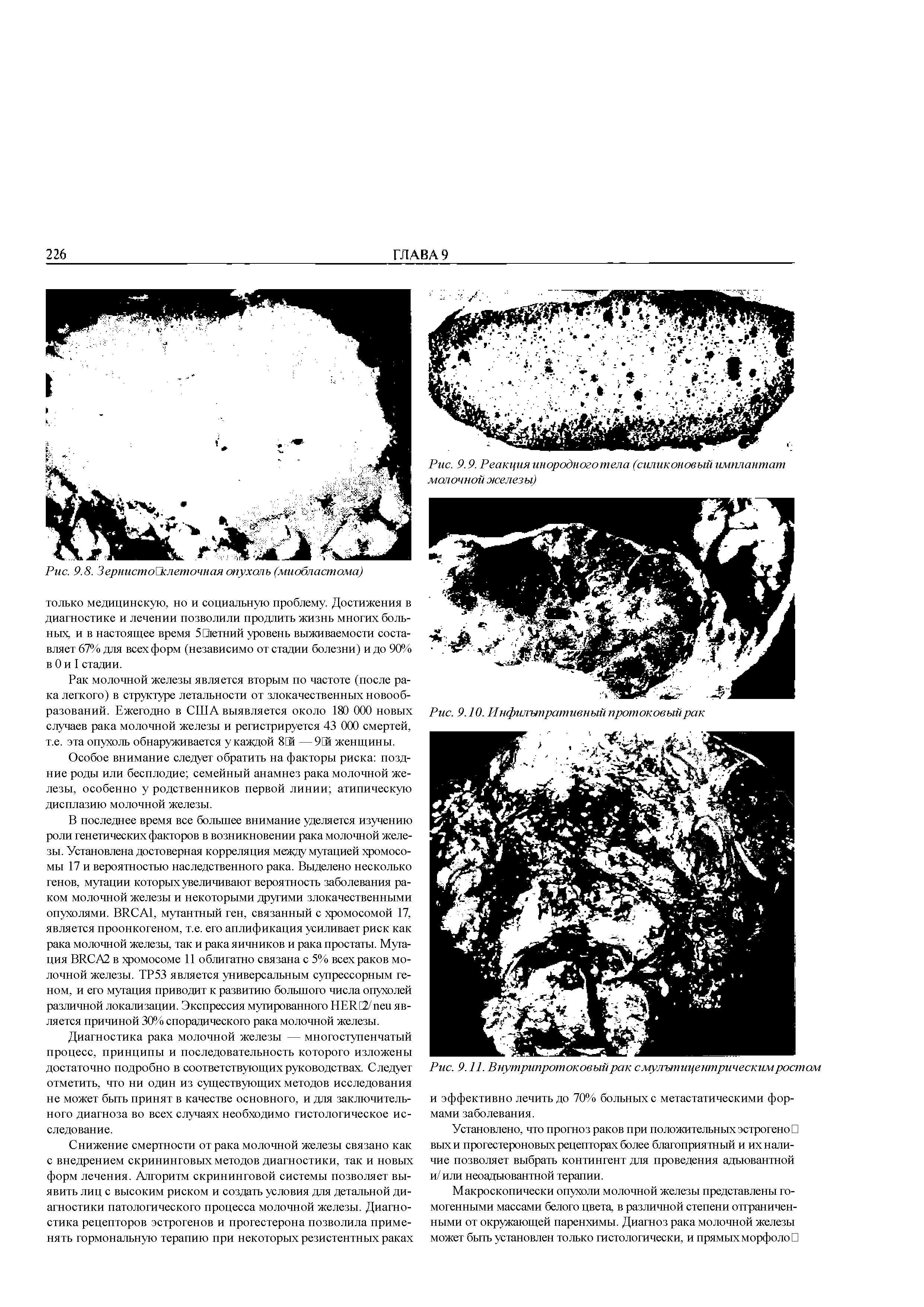 Рис. 9.9. Реакция инородноготела (силиконовый имплантат молочной железы)...