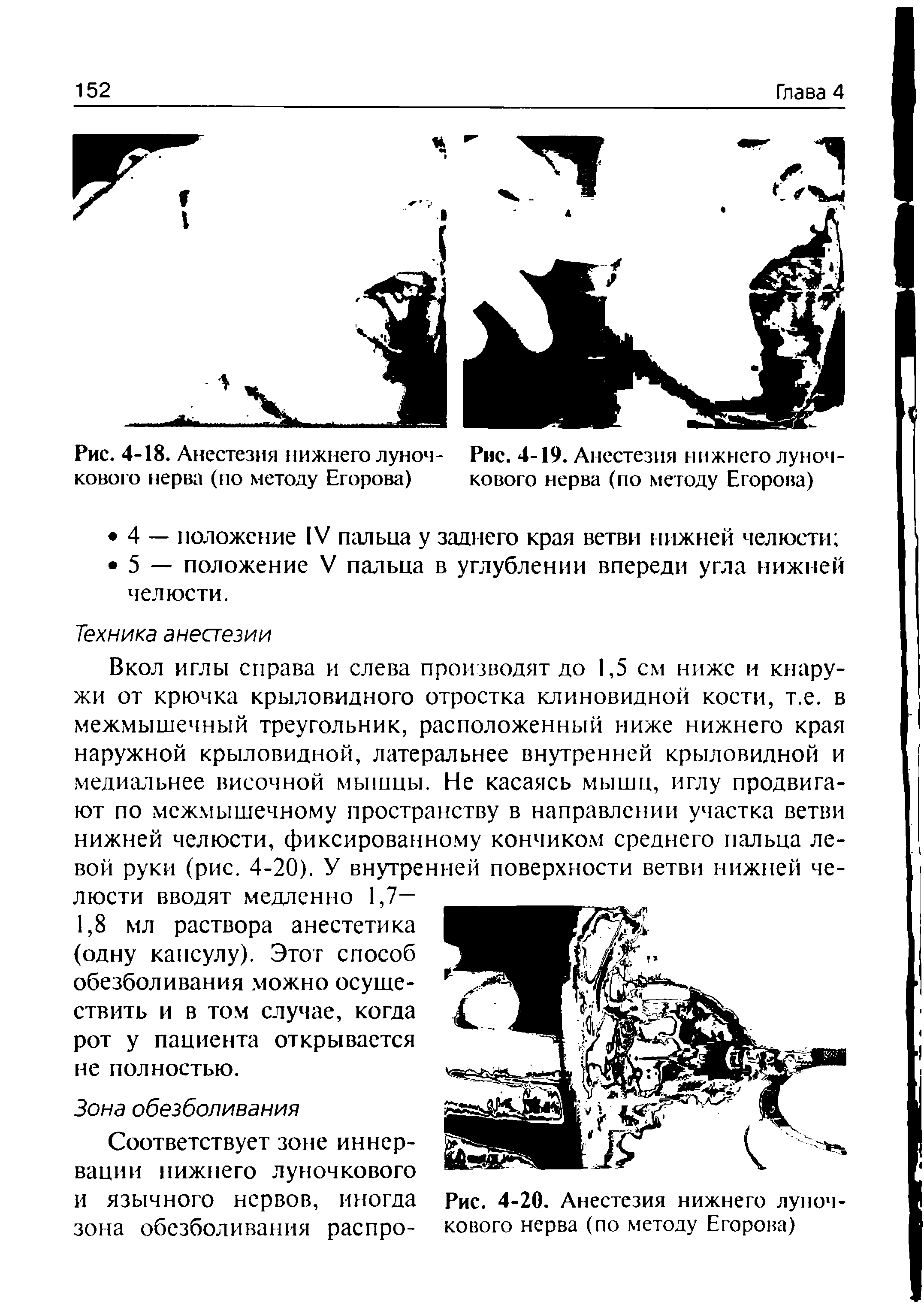 Рис. 4-20. Анестезия нижнего луночкового нерва (по методу Егорова)...