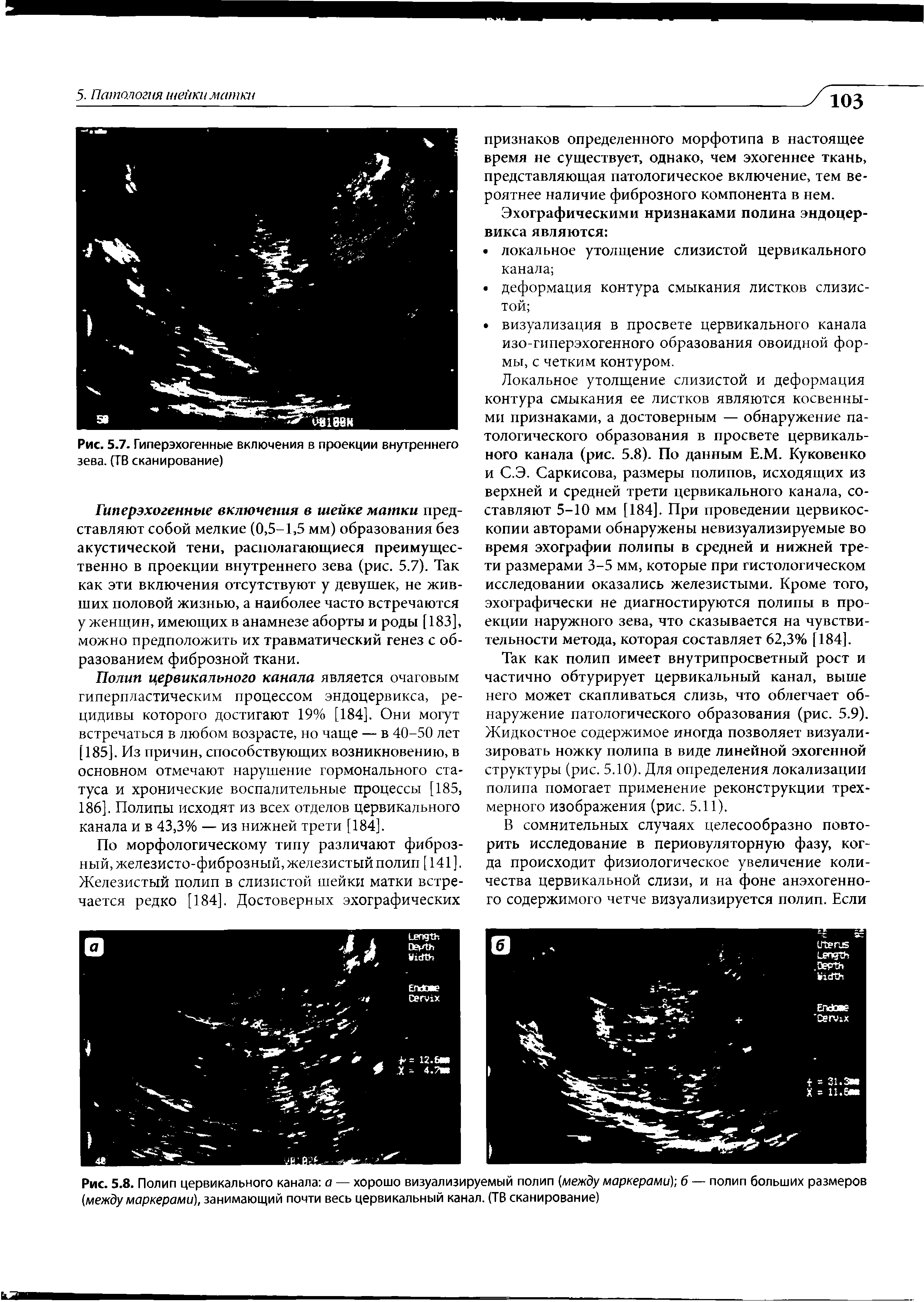 Рис. 5.8. Полип цервикального канала а — хорошо визуализируемый полип (между маркерами) б — полип больших размеров (между маркерами), занимающий почти весь цервикальный канал. (ТВ сканирование)...