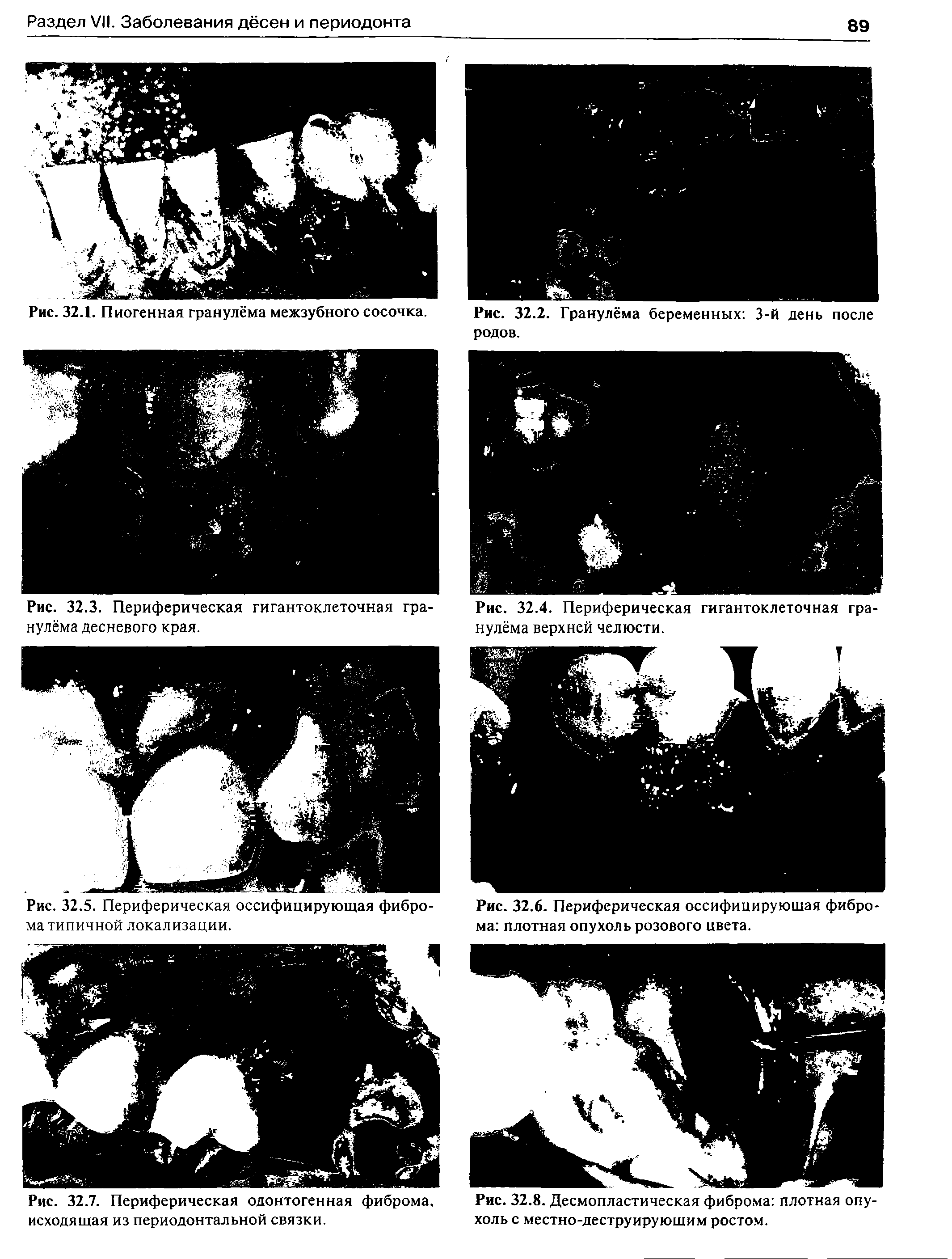 Рис. 32.7. Периферическая одонтогенная фиброма, исходящая из периодонтальной связки.