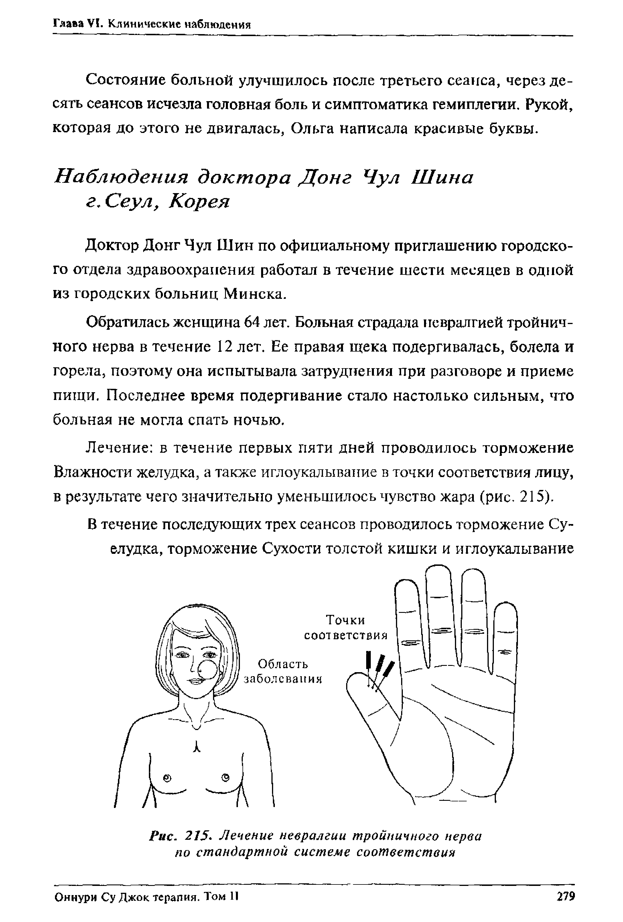 Рис. 215. Лечение невралгии тройничного нерва по стандартной системе соответствия...