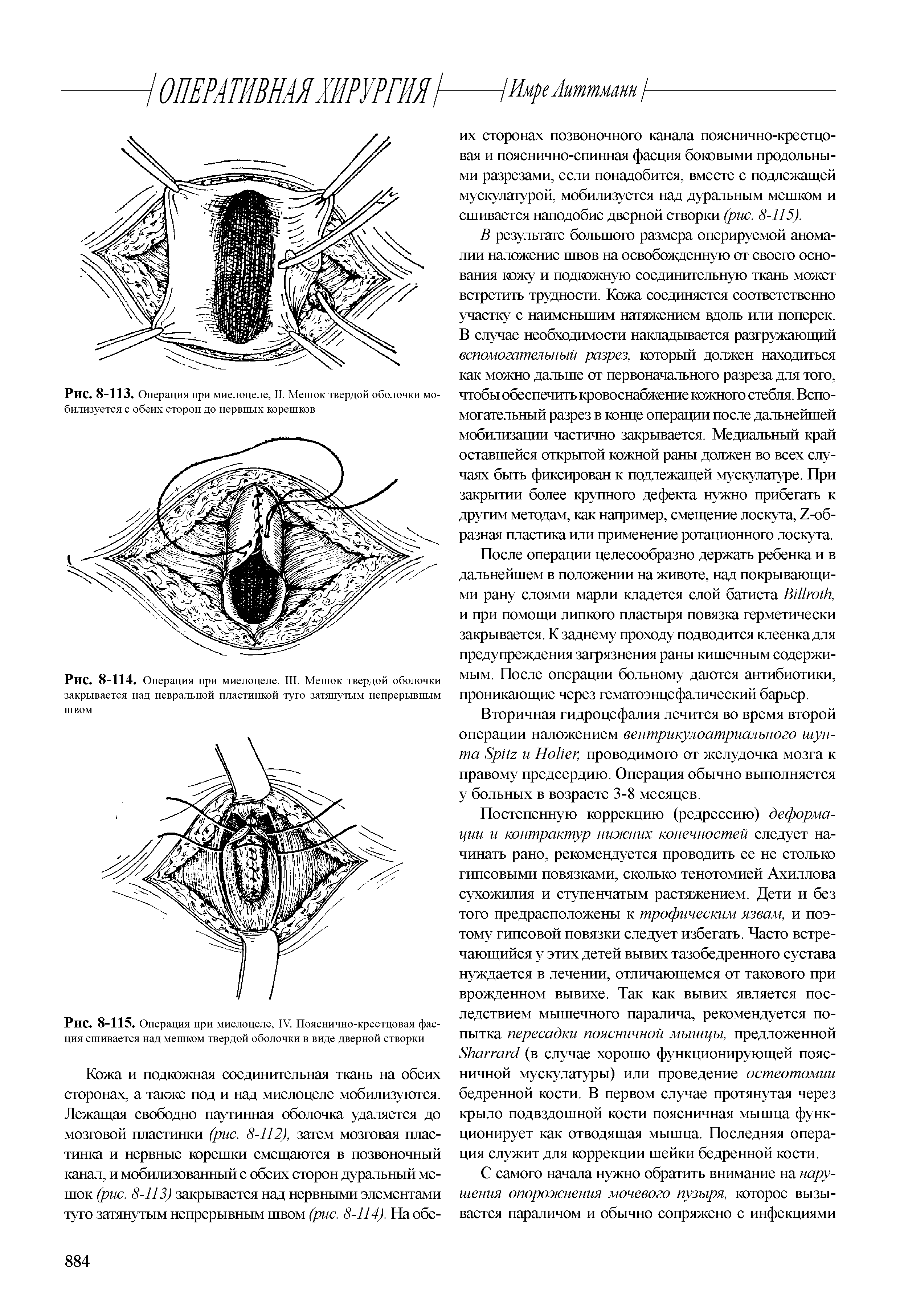 Рис. 8-115. Операция при миелоцеле, IV. Пояснично-крестцовая фасция сшивается над мешком твердой оболочки в виде дверной створки...