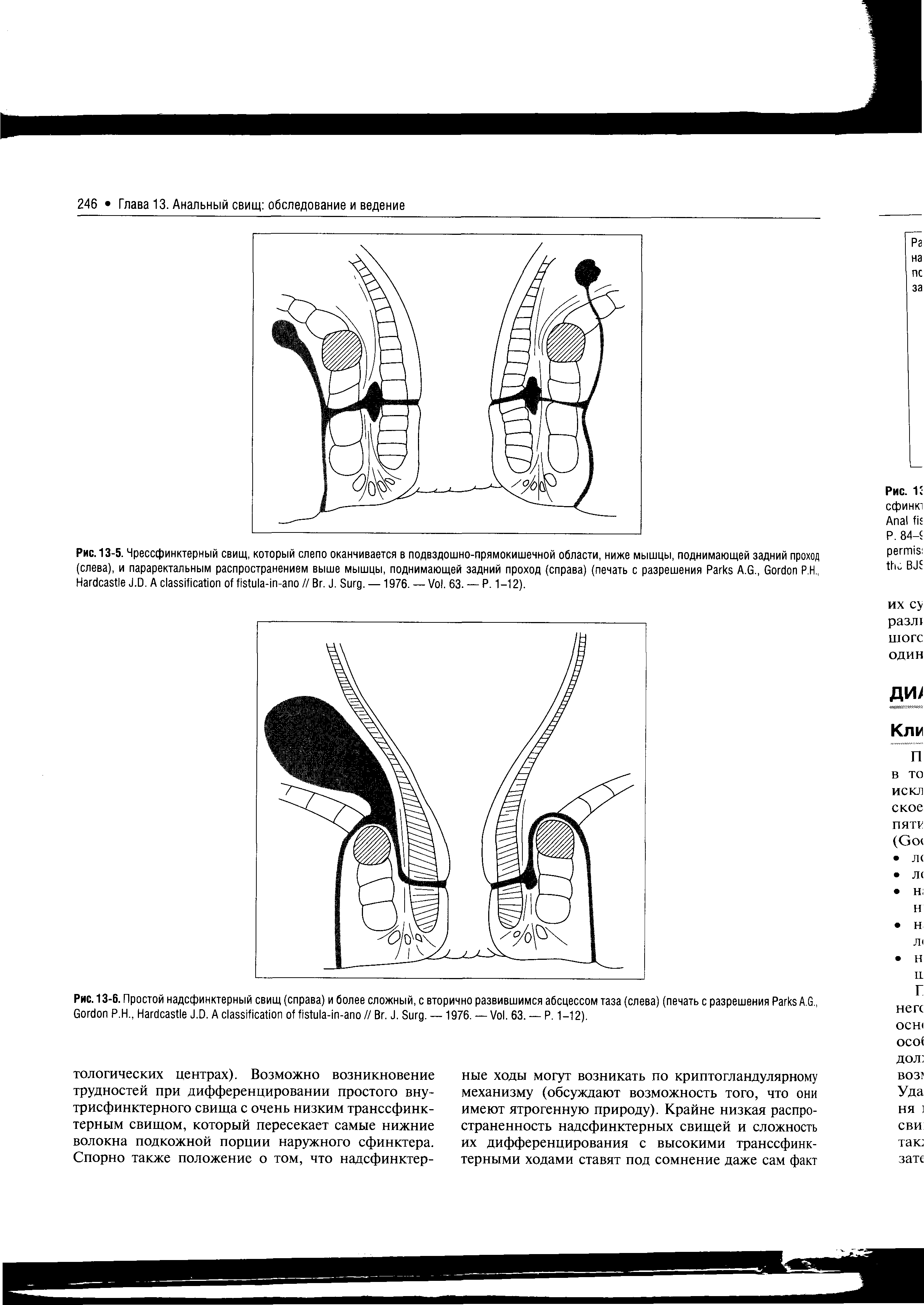 Рис. 13-6. Простой надсфинктерный свищ (справа) и более сложный, с вторично развившимся абсцессом таза (слева) (печать с разрешения P A.G., G Р.Н., H J.D. A - - // B . J. S . — 1976. — V . 63. — P. 1-12).