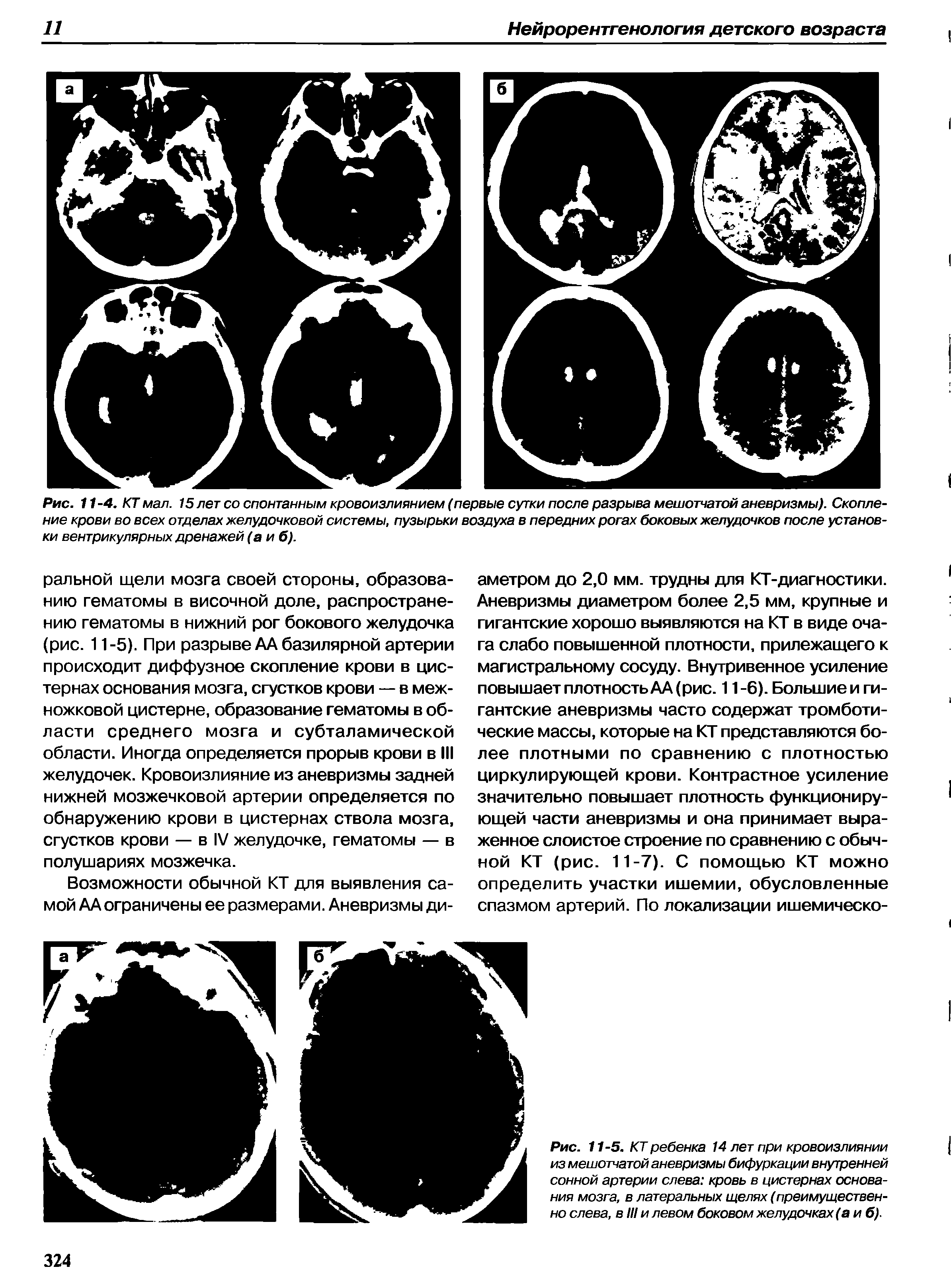 Рис. 11-5. КТ ребенка 14 лет при кровоизлиянии из мешотчатой аневризмы бифуркации внутренней сонной артерии слева кровь в цистернах основания мозга, в латеральных щелях (преимущественно слева, в III и левом боковом желудочках (а и б).