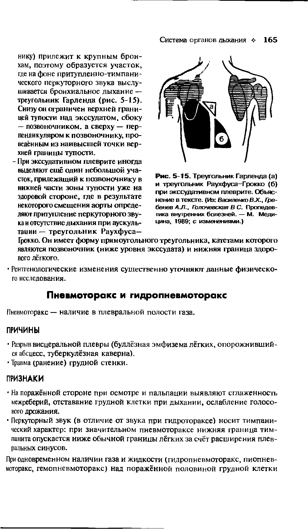 Рис. 5-15. Треугольник Гарленда (а) и треугольник Раухфуса-Грокко (б) при экссудативном плеврите. Объяснение в тексте. (Из Василенко ВЛ., Гребенев АЛ.. Голочевская В С. Пропедевтика внутренних болезней. — М. Медицина, 1989 с изменениями.)...