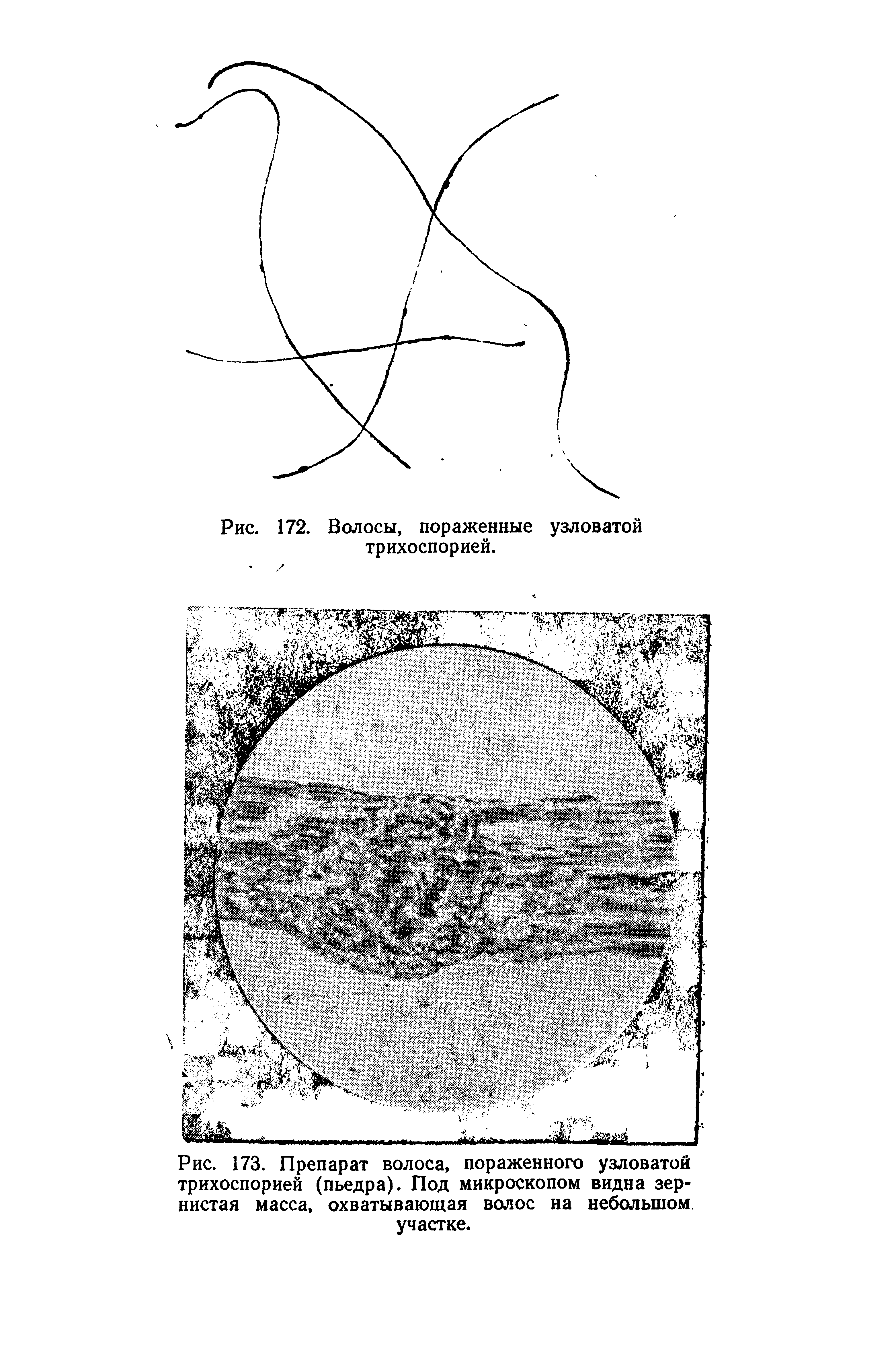Рис. 173. Препарат волоса, пораженного узловатой трихоспорией (пьедра). Под микроскопом видна зернистая масса, охватывающая волос на небольшом участке.