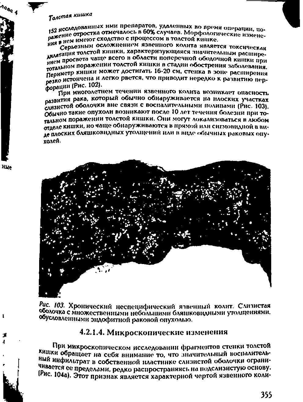 Рис. 103. Хронический неспецифический язвенный колит. Слизистая Волочка с множественными небольшими бляшковидными утолщениями, условленными эндофитной раковой опухолью.