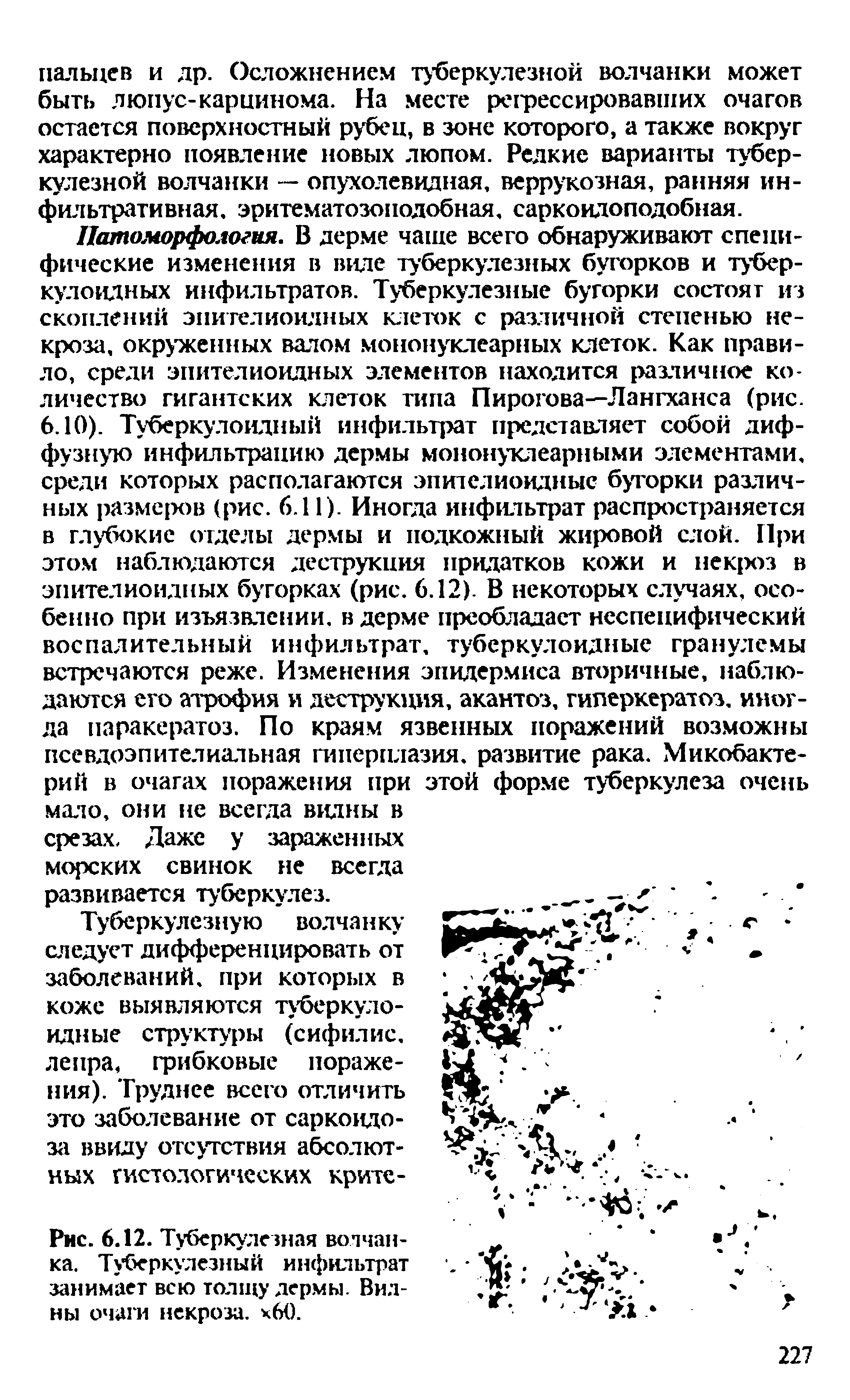 Рис. 6.12. Туберкулезная волчанка. Туберкулезный инфильтрат занимает всю толщу дермы. Видны очаги некроза. х60.