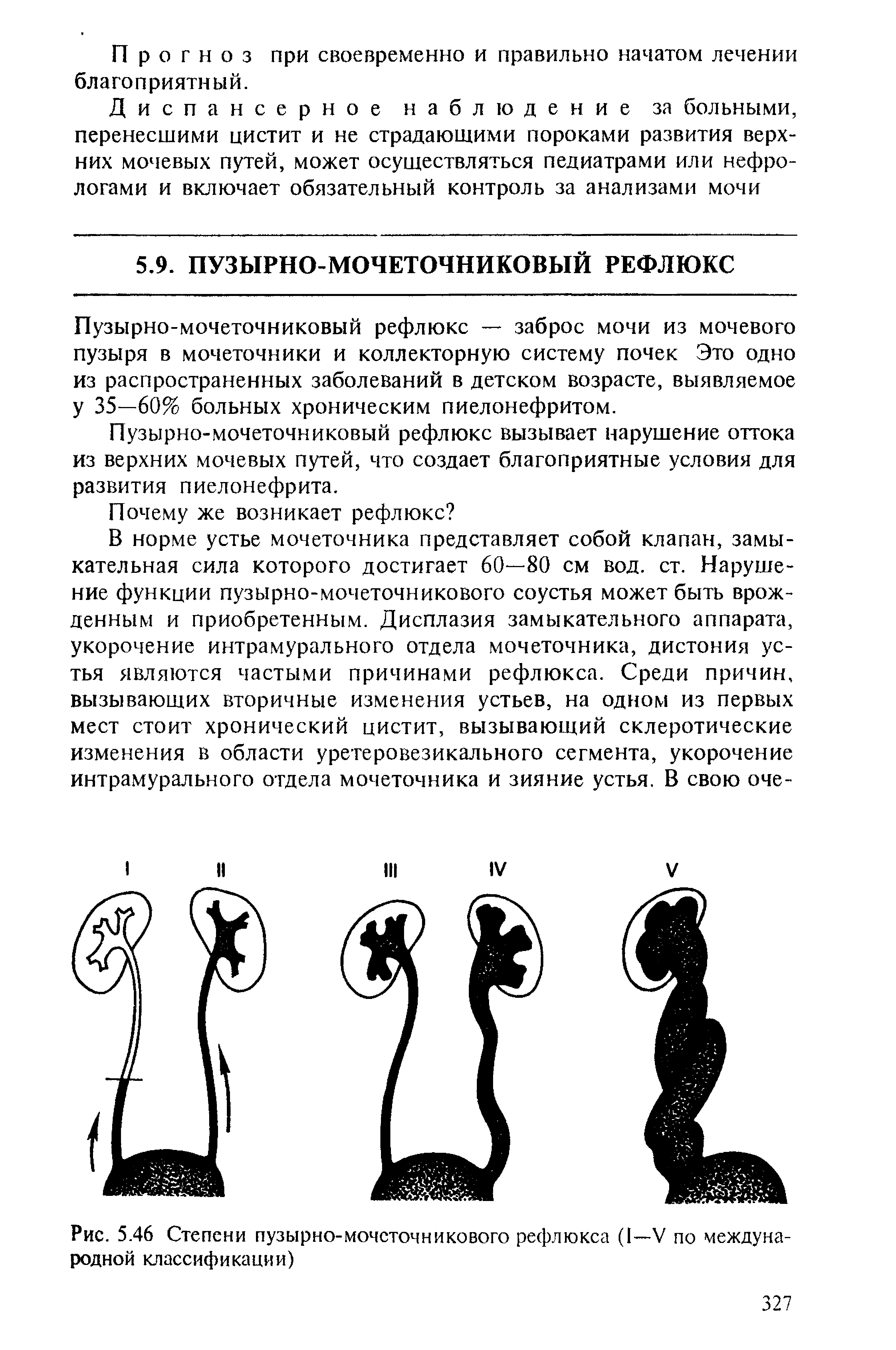 Рис. 5.46 Степени пузырно-мочеточникового рефлюкса (I—V по международной классификации)...