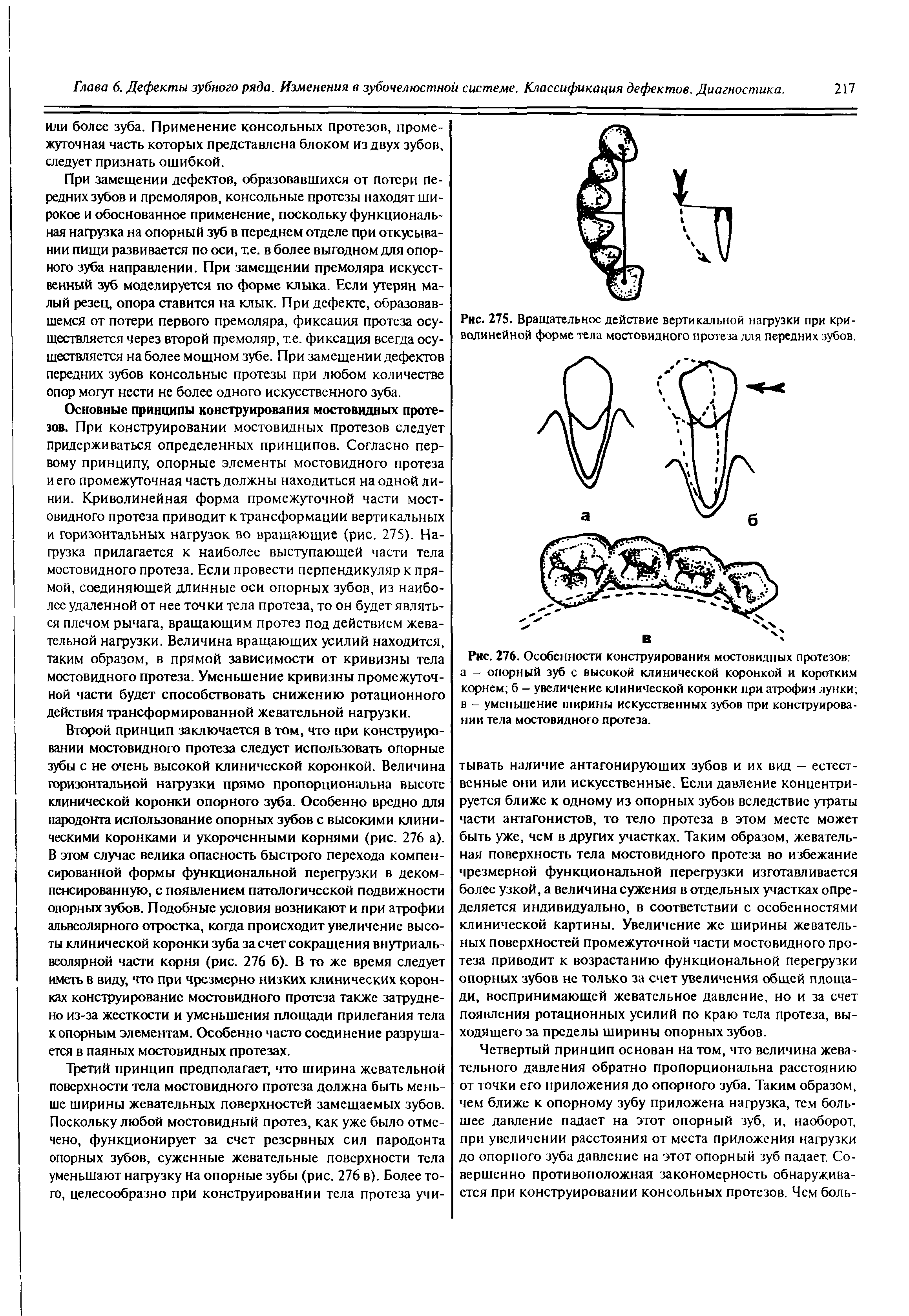 Рис. 276. Особенности конструирования мостовидных протезов а - опорный зуб с высокой клинической коронкой и коротким корнем б - увеличение клинической коронки при атрофии лунки в - уменьшение ширины искусственных зубов при конструировании тела мостовидного протеза.