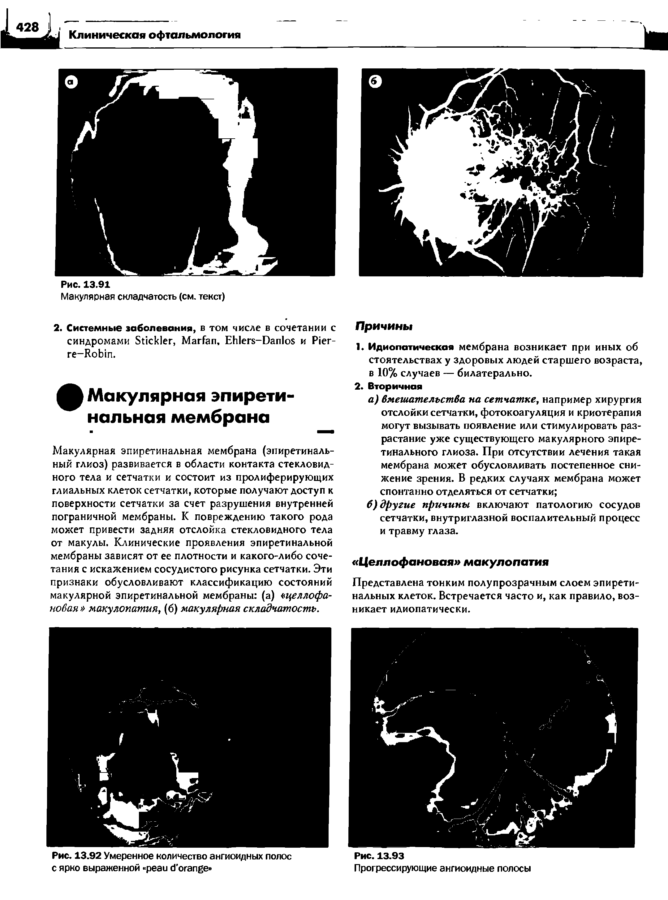 Рис. 13.92 Умеренное количество ангиоидных полос с ярко выраженной ...