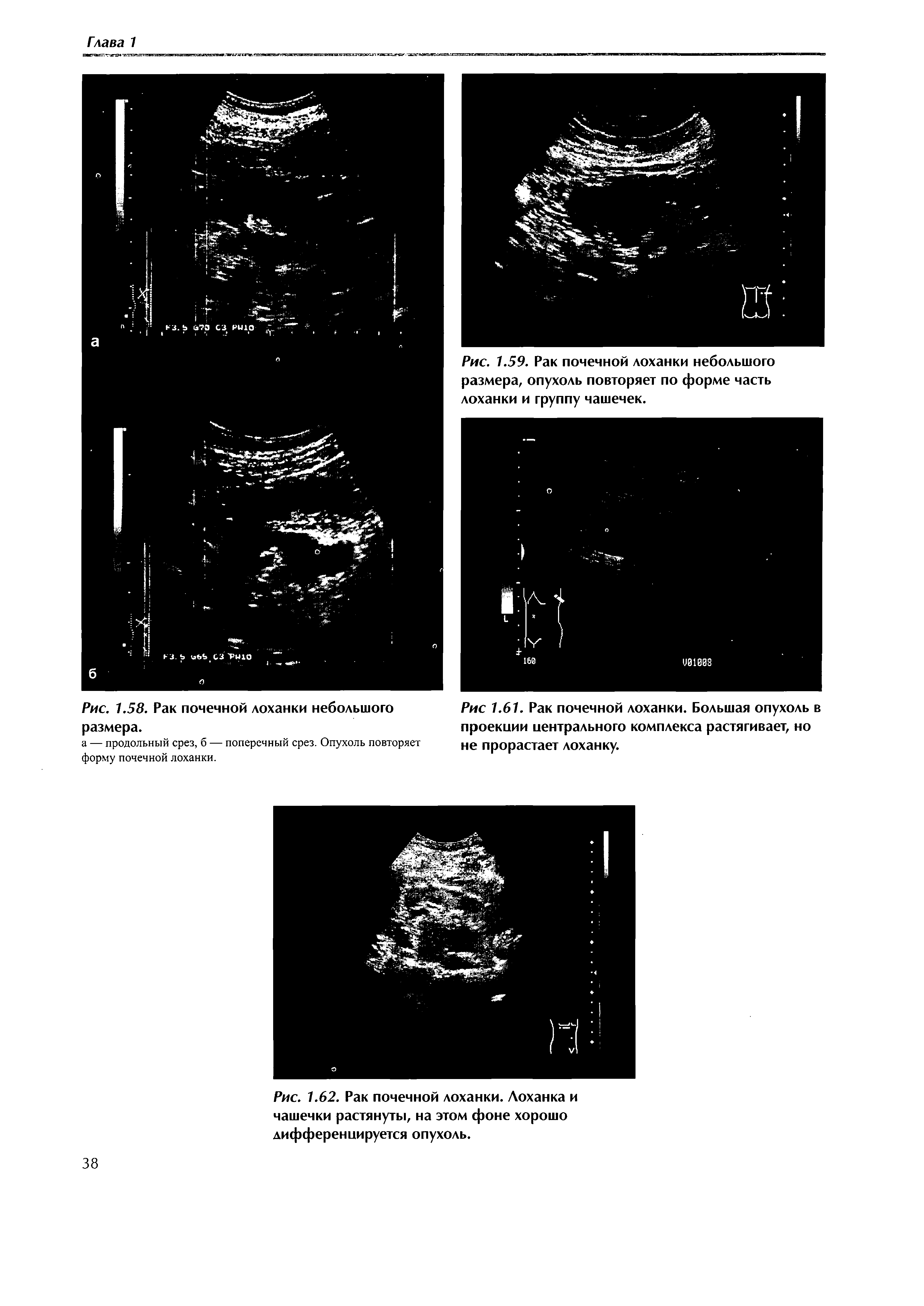 Рис. 1.62. Рак почечной лоханки. Лоханка и чашечки растянуты, на этом фоне хорошо дифференцируется опухоль.