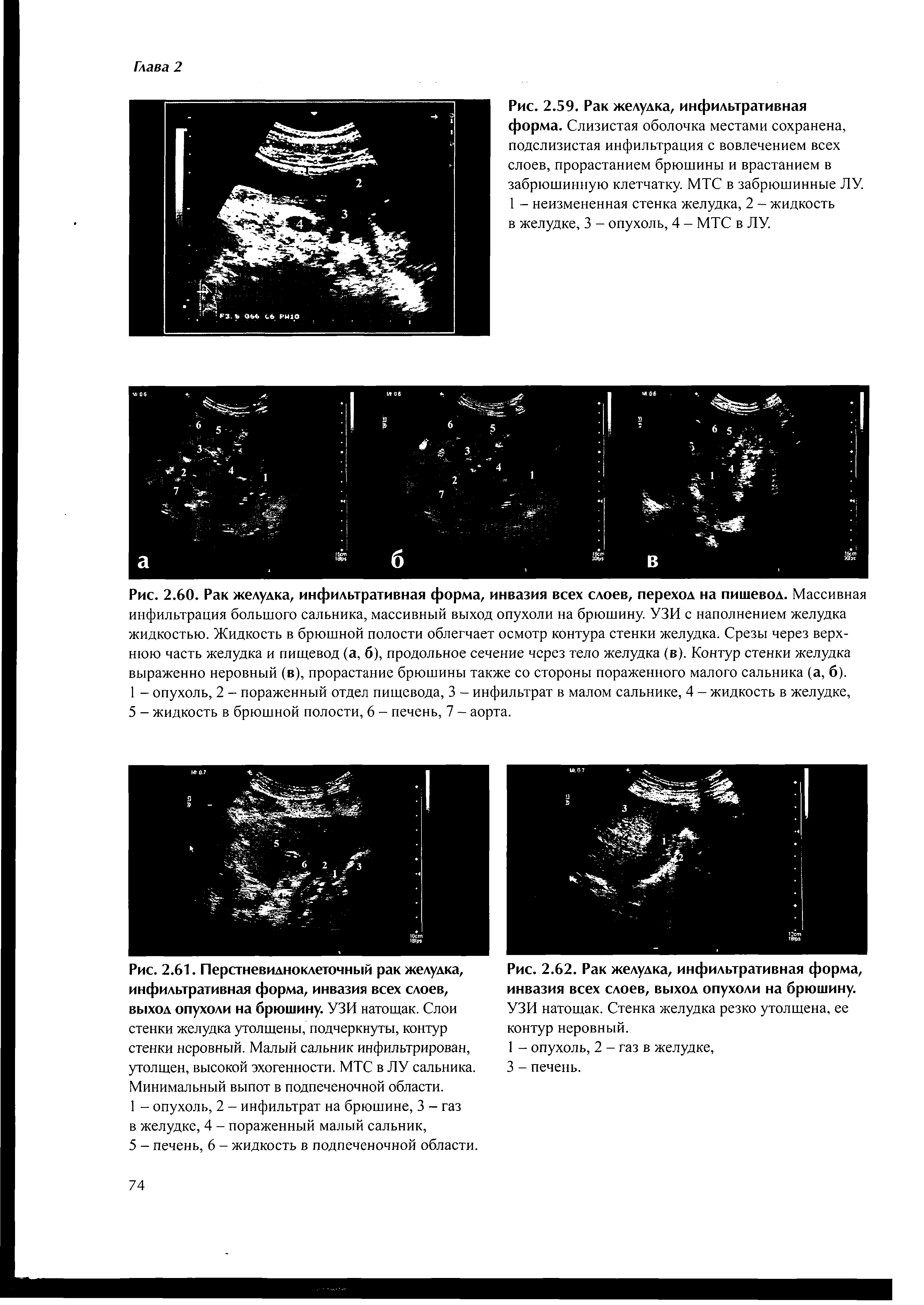 Рис. 2.59. Рак желудка, инфильтративная форма. Слизистая оболочка местами сохранена, подслизистая инфильтрация с вовлечением всех слоев, прорастанием брюшины и врастанием в забрюшинную клетчатку. МТС в забрюшинные ЛУ. 1 - неизмененная стенка желудка, 2 - жидкость в желудке, 3 - опухоль, 4 - МТС в ЛУ.