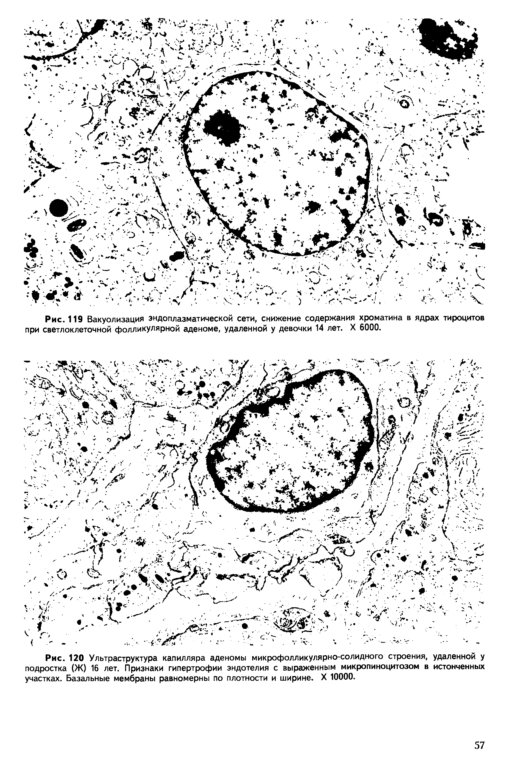 Рис. 120 Ультраструктура капилляра аденомы микрофолликулярно-солидного строения, удаленной у подростка (Ж) 16 лет. Признаки гипертрофии эндотелия с выраженным микропиноцитозом в истонченных участках. Базальные мембраны равномерны по плотности и ширине. X 10000.