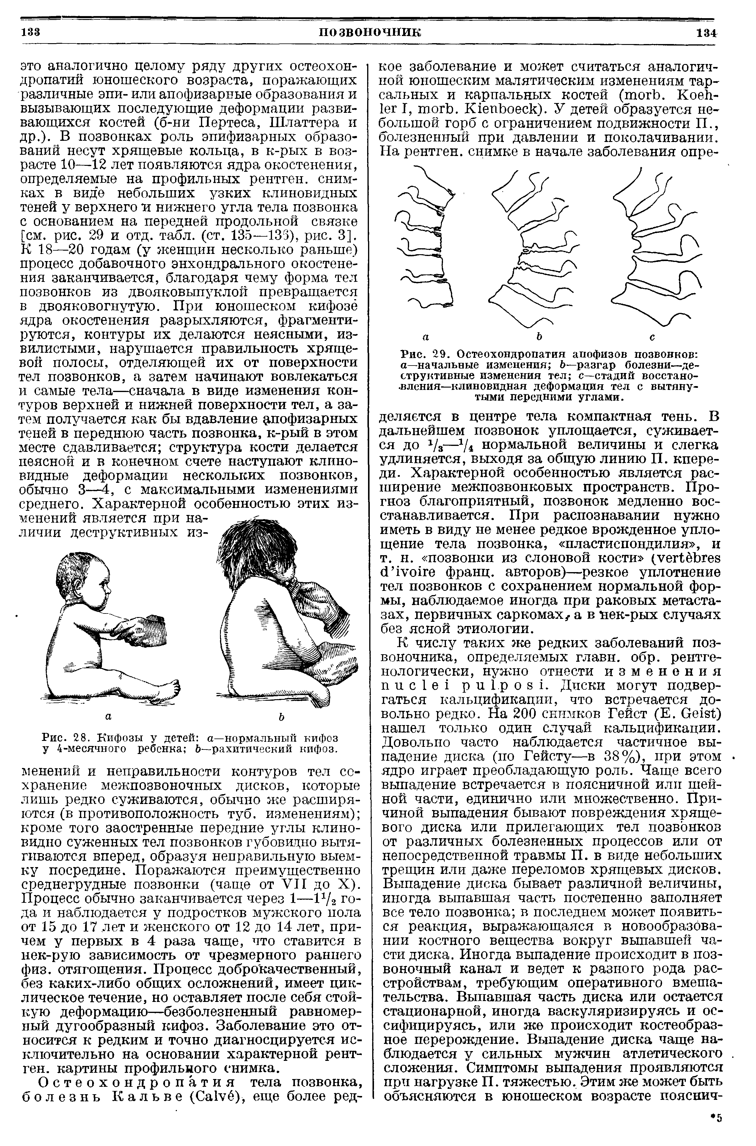 Рис. 28. Кифозы у детей а—нормальный кифоз у 4-месячного ребенка Ь рахитический кифоз.