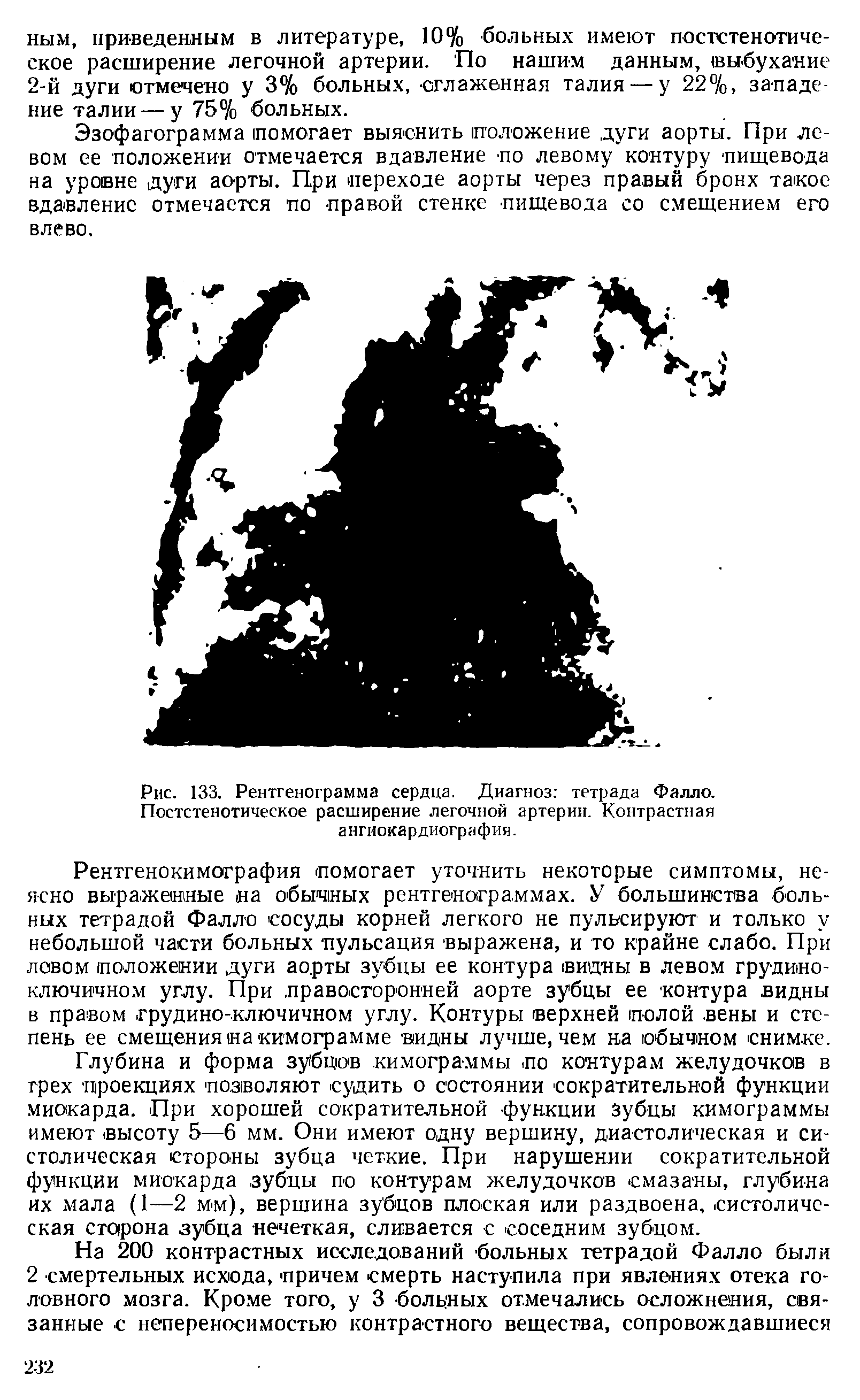 Рис. 133. Рентгенограмма сердца. Диагноз тетрада Фалло. Постстенотическое расширение легочной артерии. Контрастная ангиокардиография.