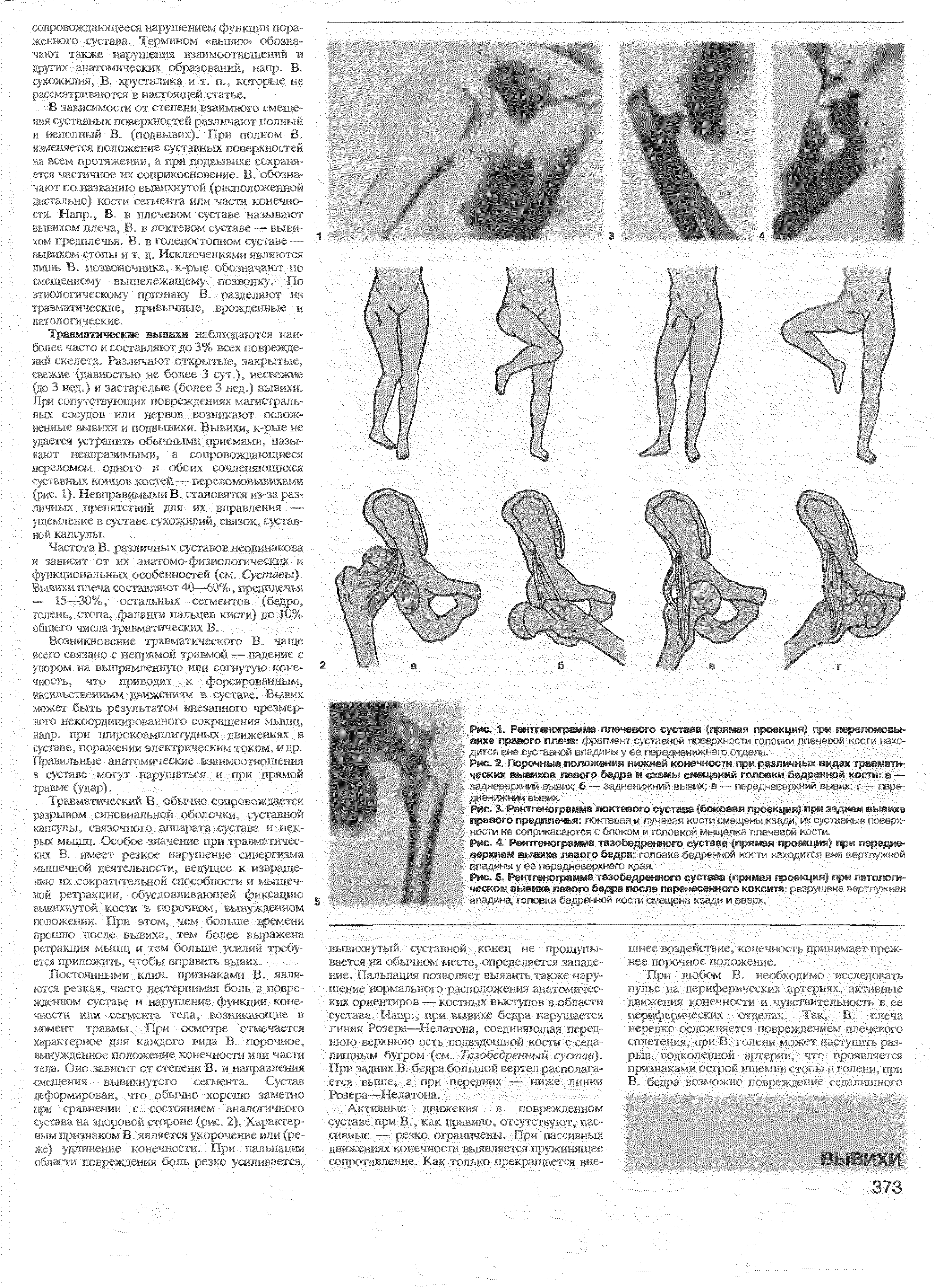 Рис. 2. Порочные положения нижней конечности при различных видах траамати-,.х вывихов левого бедра и схемы смещений головки бедренной кости, а — адневерхнии вывих б.. дненижний вь и в — 1 . ы их г— ...