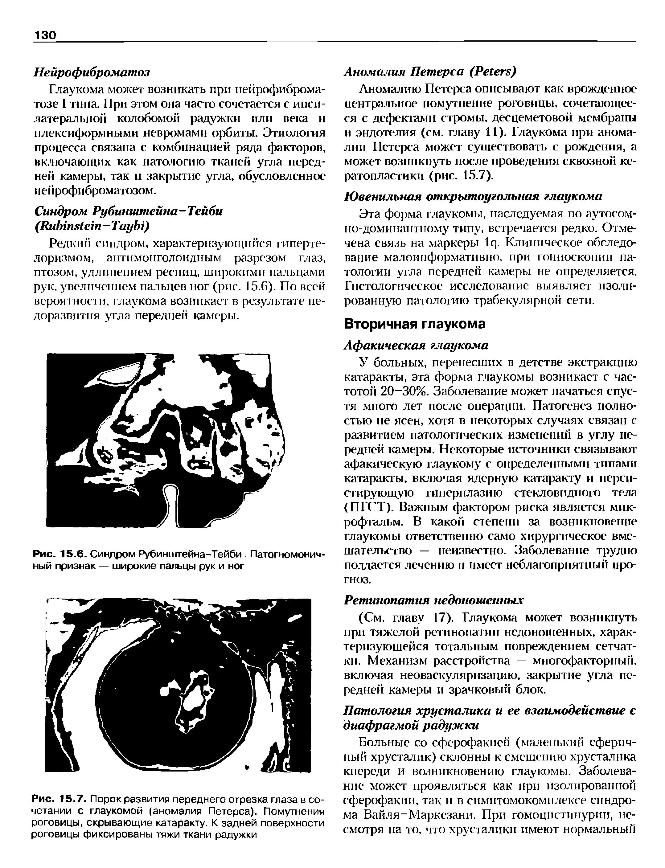 Рис. 15.7. Порок развития переднего отрезка глаза в сочетании с глаукомой (аномалия Петерса). Помутнения роговицы, скрывающие катаракту. К задней поверхности роговицы фиксированы тяжи ткани радужки...