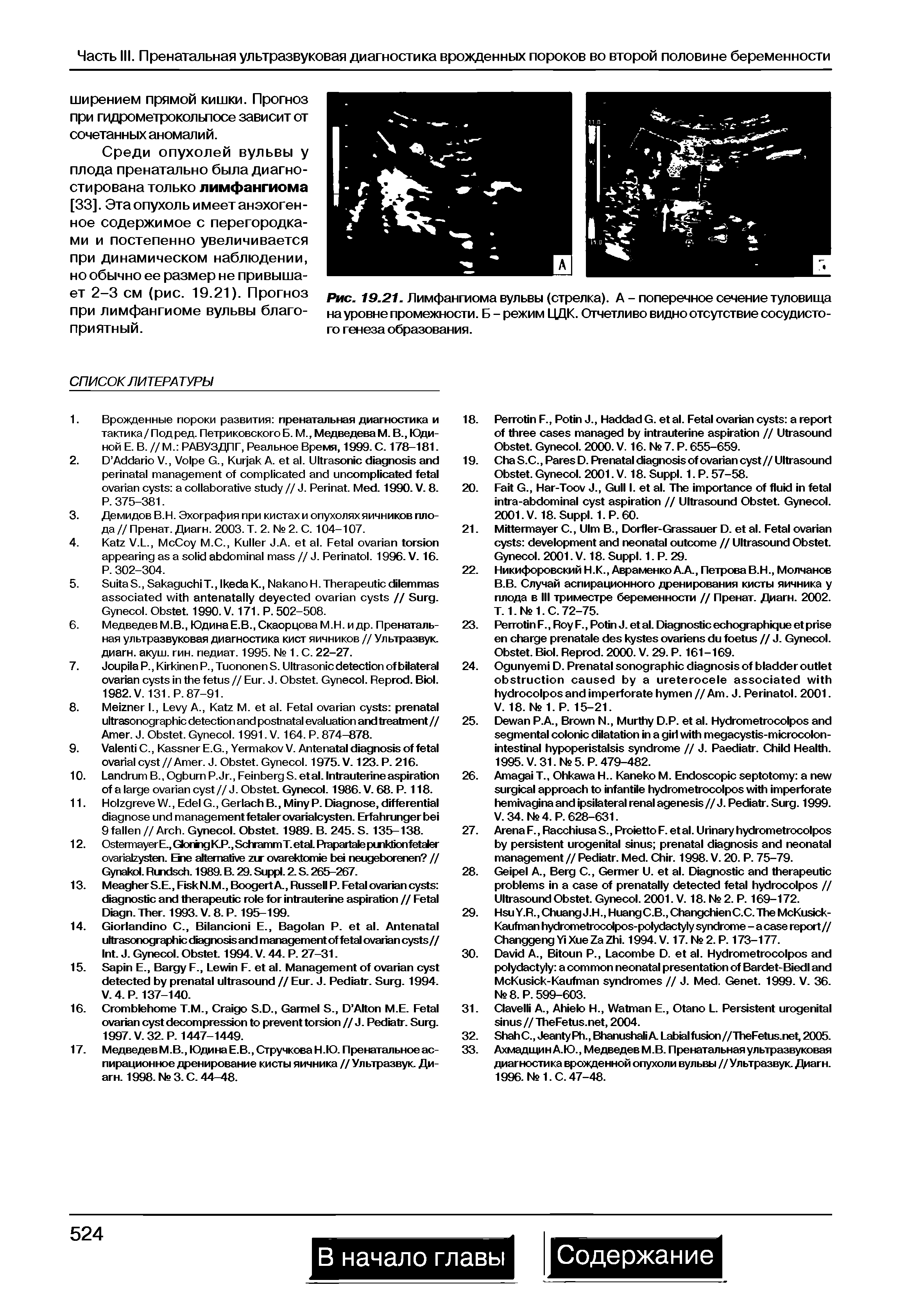 Рис. 19.21. Лимфангиома вульвы (стрелка). А - поперечное сечение туловища на уровне промежности. Б-режим ЦДК. Отчетливо видно отсутствие сосудистого генеза образования.