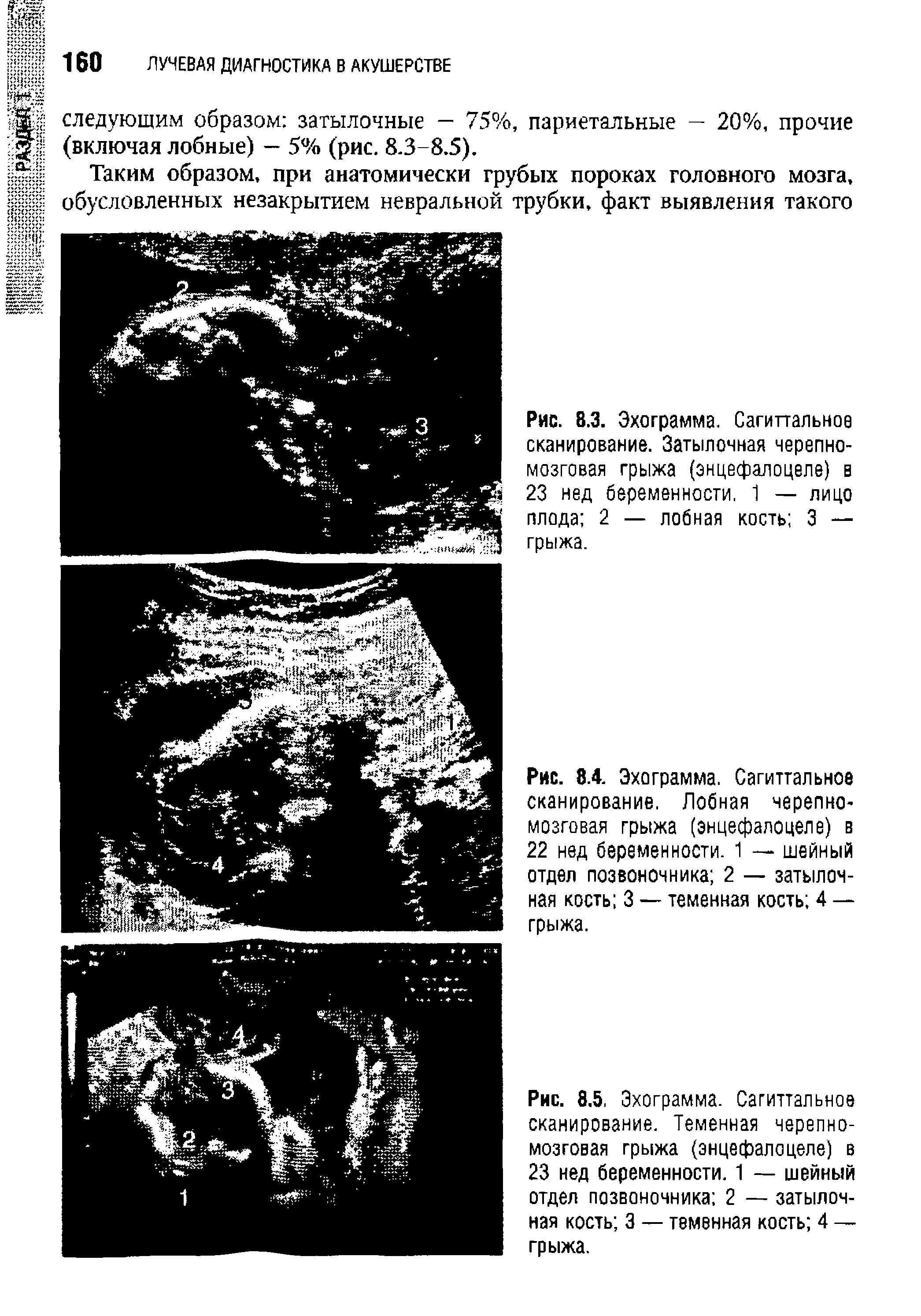 Рис. 8.4. Эхограмма. Сагиттальное сканирование. Лобная черепномозговая грыжа (энцефалоцеле) в 22 нед беременности. 1 — шейный отдел позвоночника 2 — затылочная кость 3 — теменная кость 4 — грыжа.