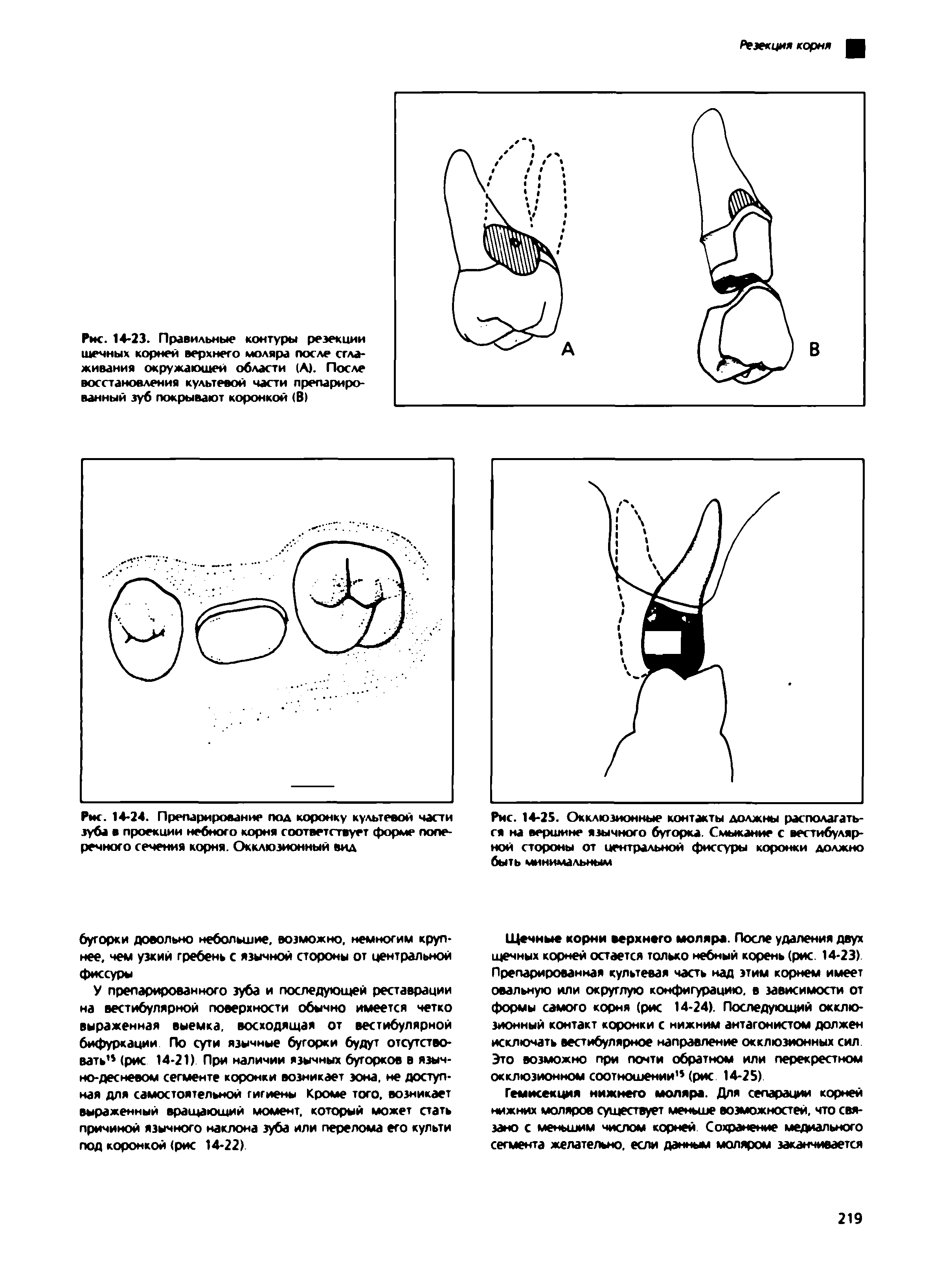 Рис. 14-24. Препарирование под коронку культевой части зуба в проекции небного корня соответствует форме поперечного сечения корня. Окклюзионный вид...