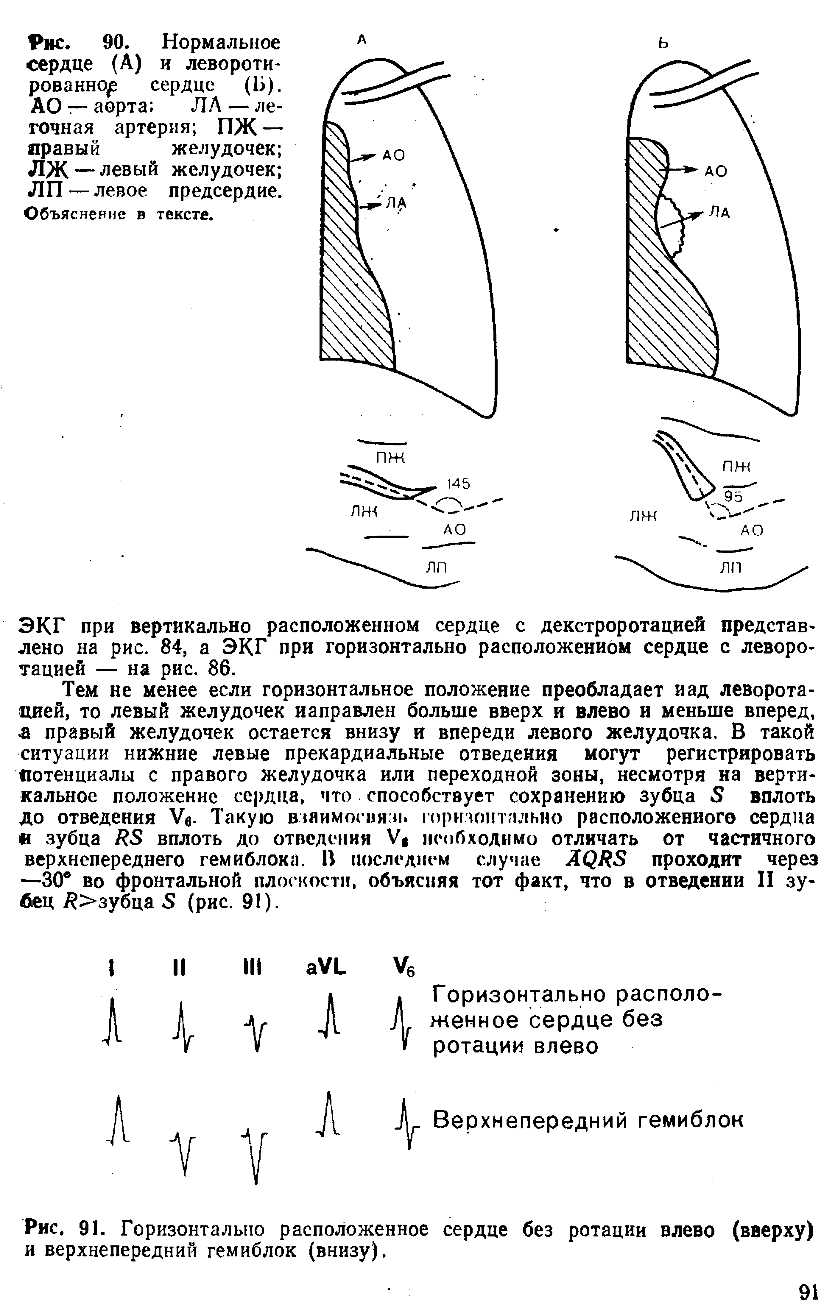 Рис. 91. Горизонтально расположенное сердце без ротации влево (вверху) и верхнепередний гемиблок (внизу).