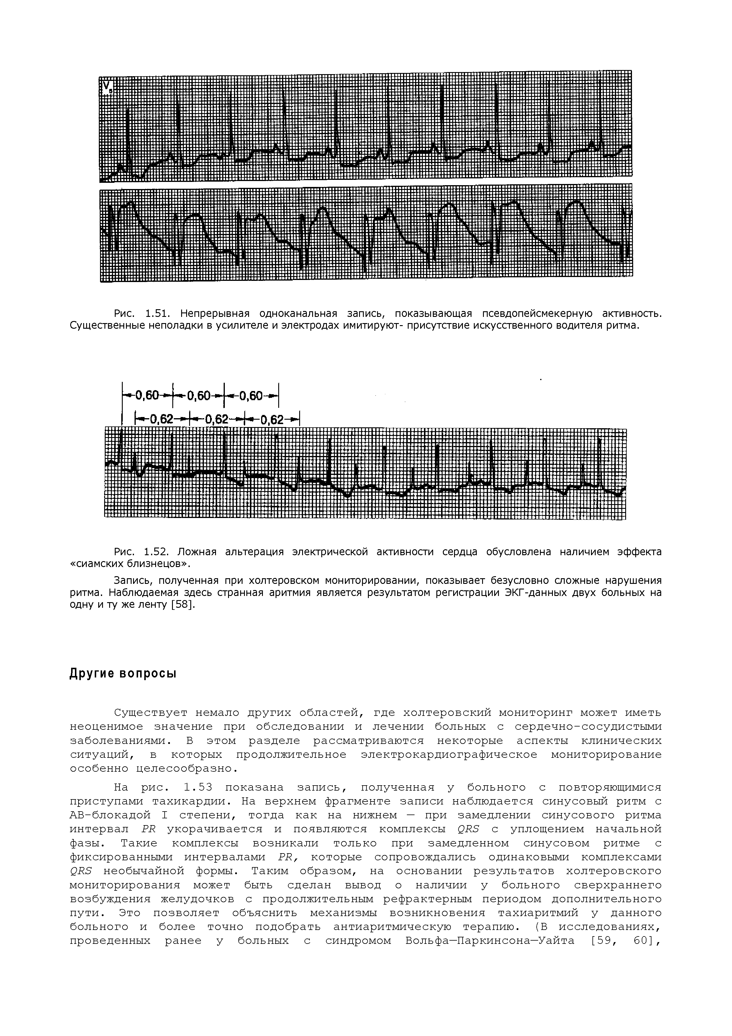 Рис. 1.52. Ложная альтерация электрической активности сердца обусловлена наличием эффекта сиамских близнецов .
