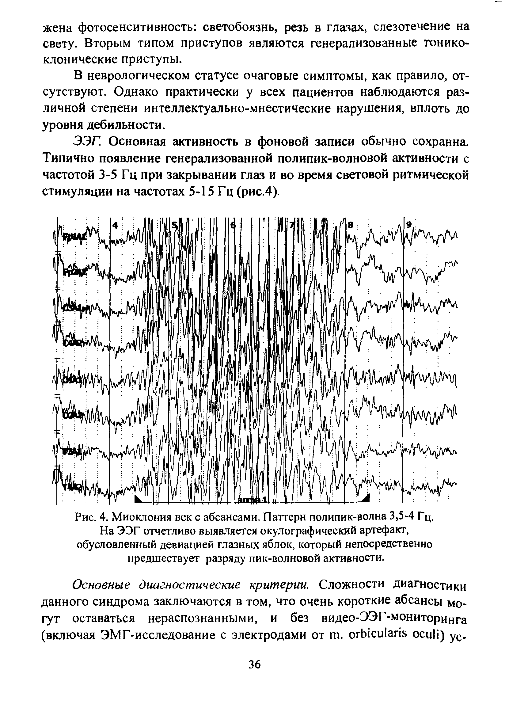 Рис. 4. Миоклония век с абсансами. Паттерн полипик-волна 3,5-4 Гц. На ЭЭГ отчетливо выявляется окулографический артефакт, обусловленный девиацией глазных яблок, который непосредственно предшествует разряду пик-волновой активности.