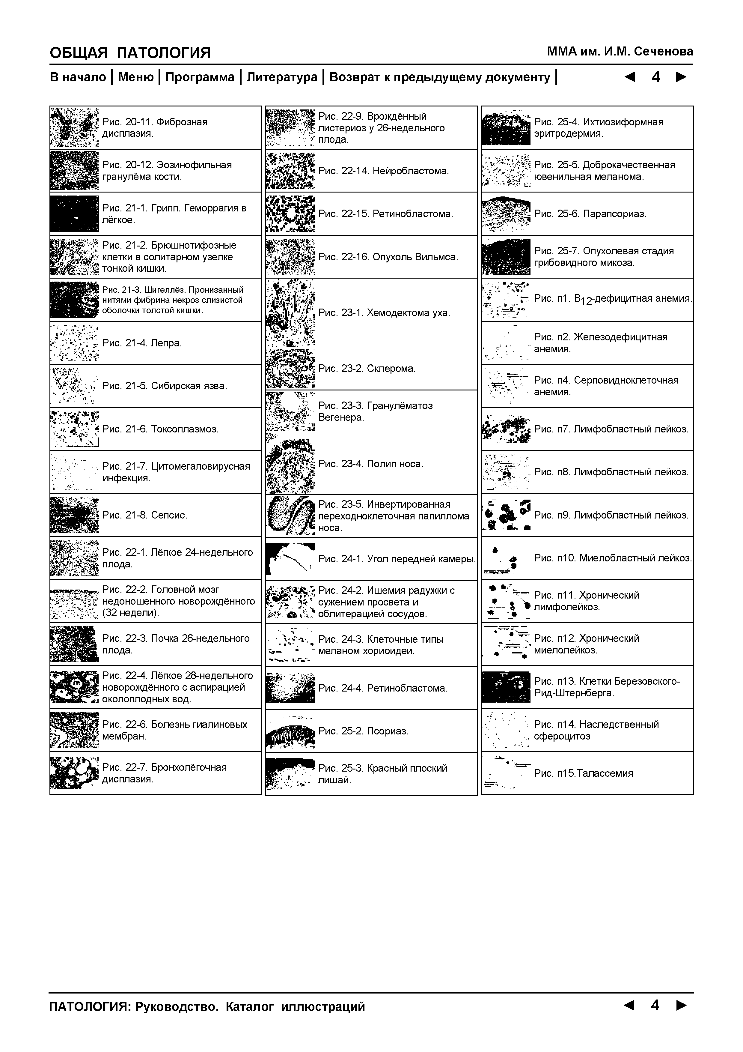 Рис. 20-12. Эозинофильная гранулёма кости. ьЗ ЗД З Рис. 22-14. Нейробластома. к Рис. 25-5. Доброкачественная . ) ювенильная меланома.