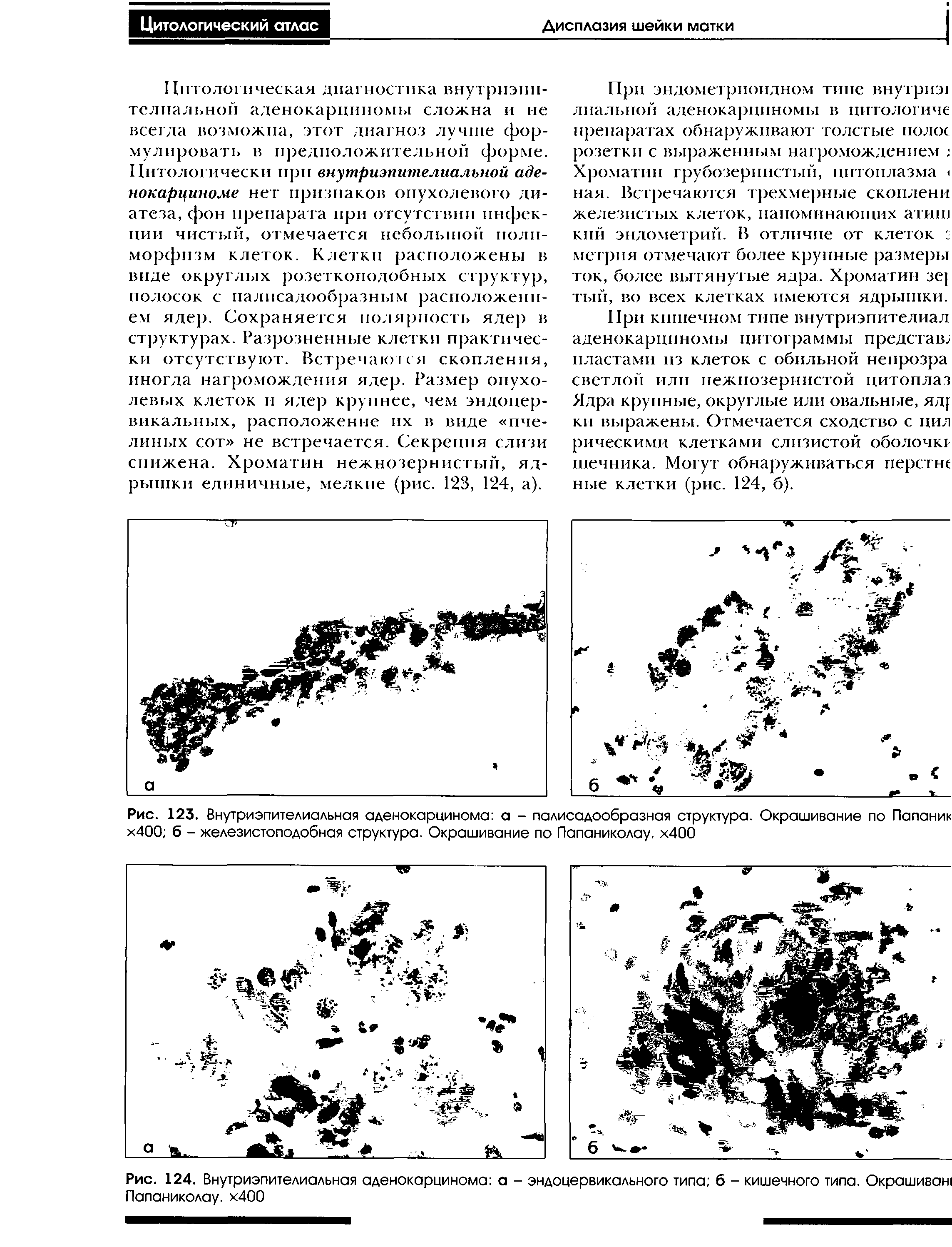 Рис. 124. Внутриэпителиальная аденокарцинома а - эндоцервикального типа б - кишечного типа. Окрашиван Папаниколау. х400...