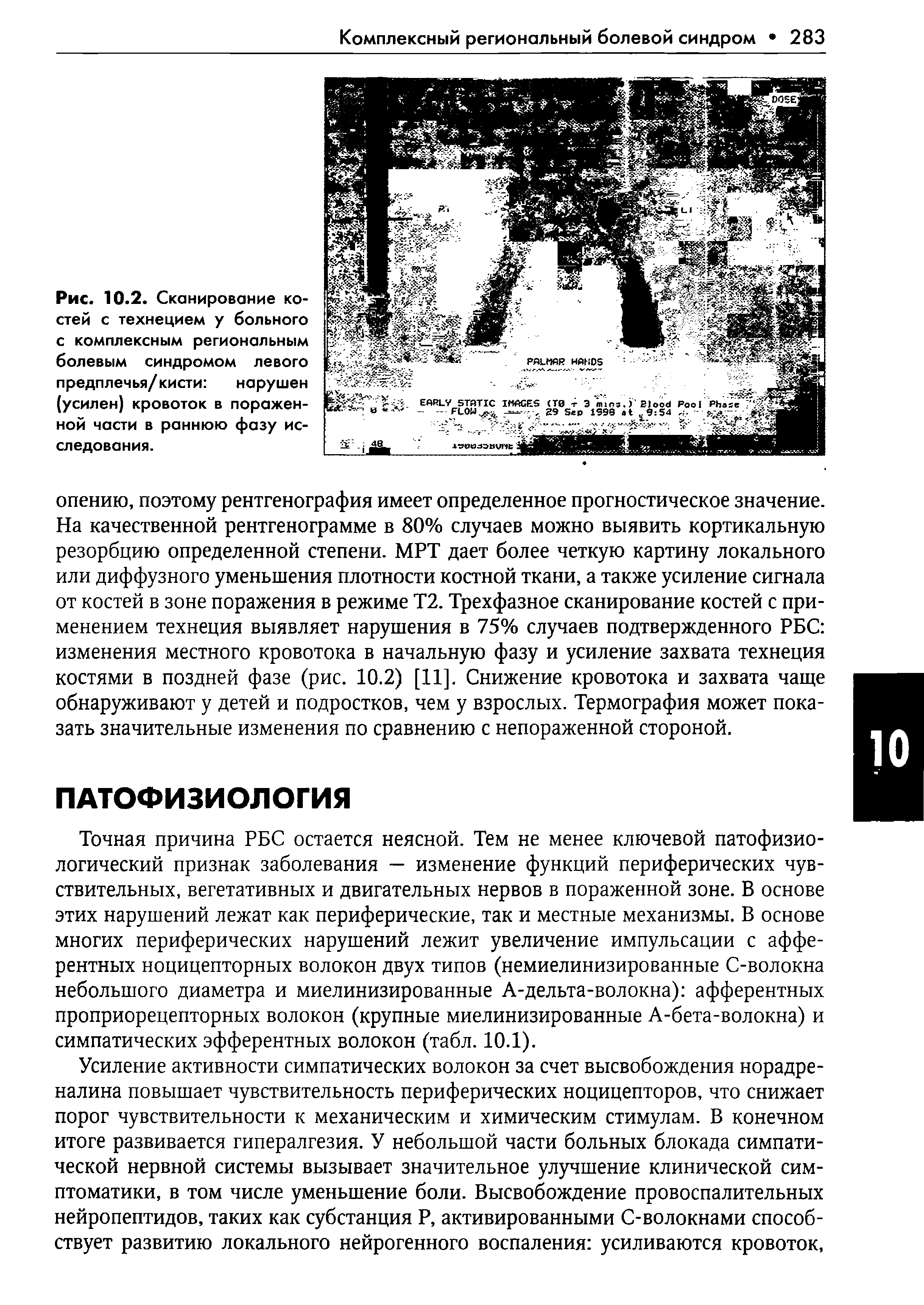 Рис. 10.2. Сканирование костей с технецием у больного с комплексным региональным болевым синдромом левого предплечья/кисти нарушен (усилен) кровоток в пораженной части в раннюю фазу исследования.