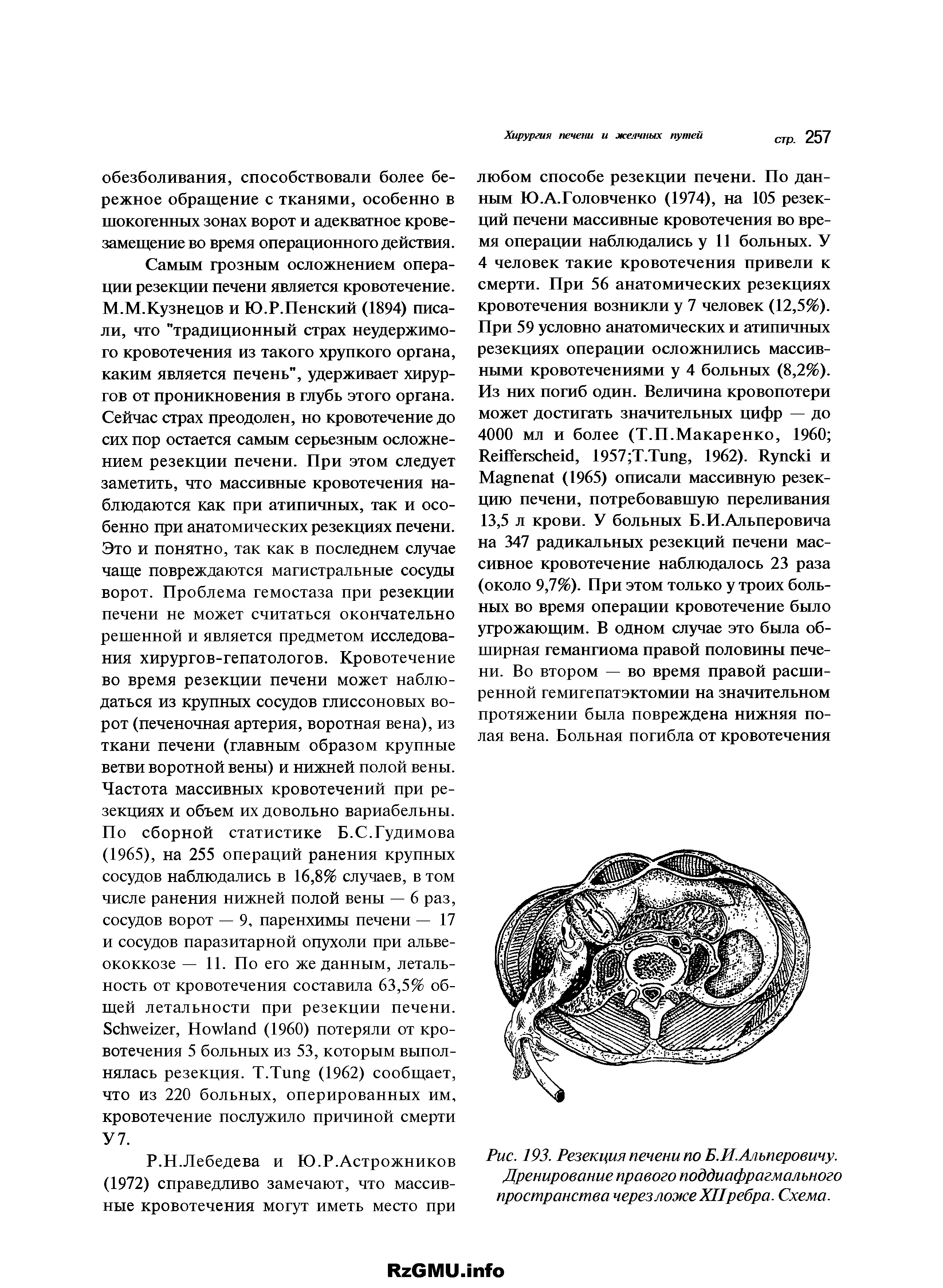 Рис. 193. Резекция печени по Б.И.Алъперовичу. Дренирование правого поддиафрагмального пространства через ложе XIIребра. Схема.