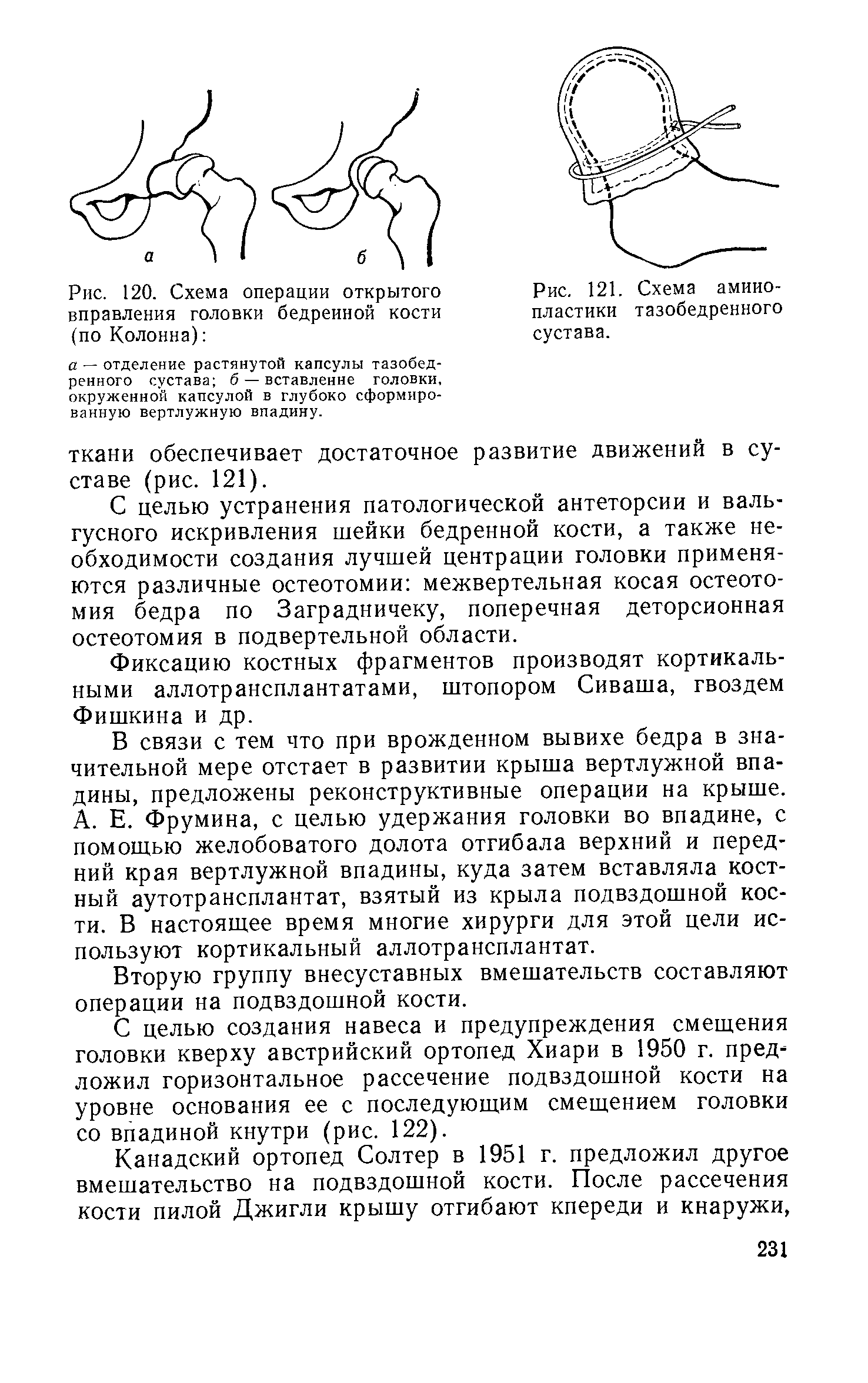 Рис. 120. Схема операции открытого вправления головки бедренной кости (по Колонна) ...