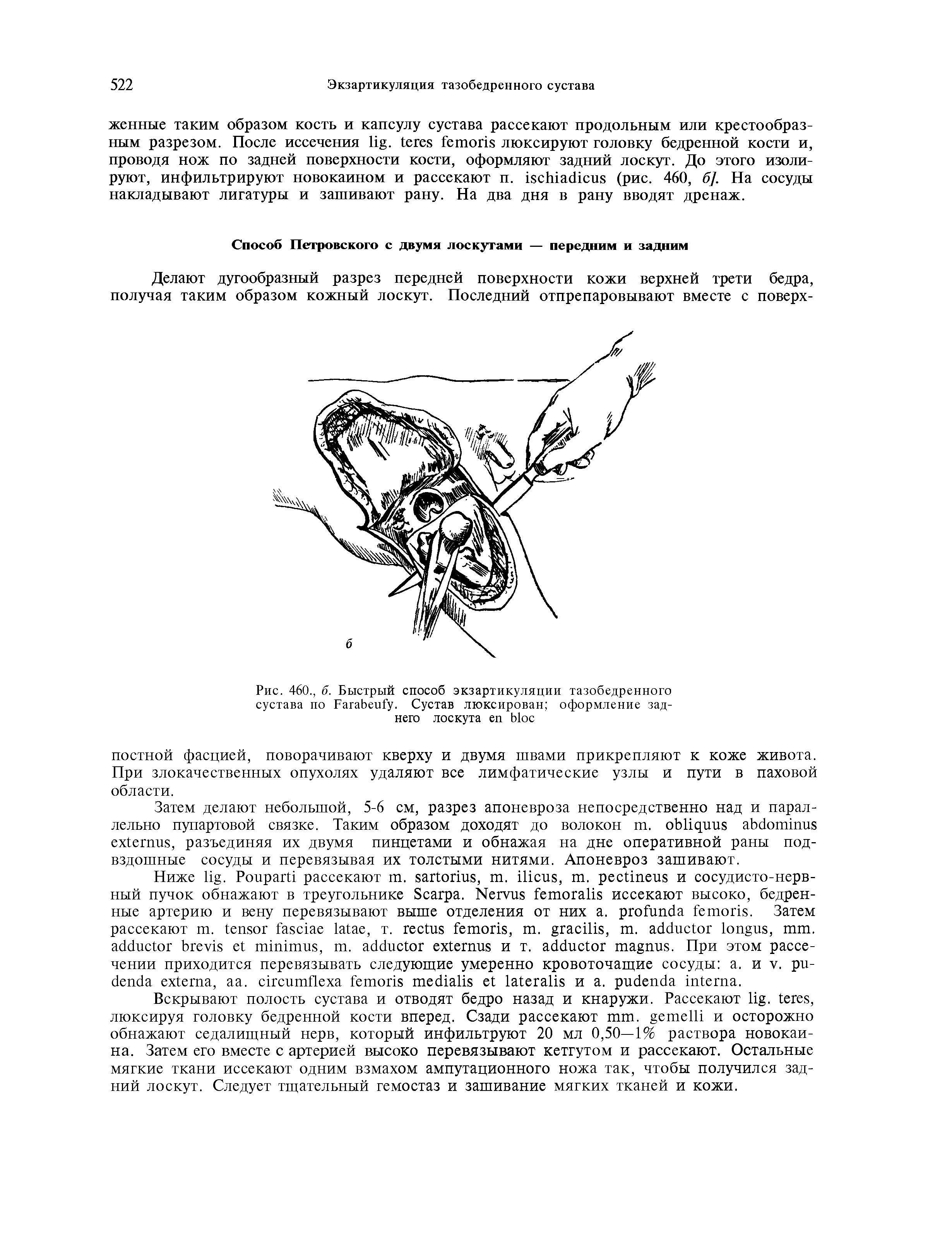 Рис. 460., 6. Быстрый способ экзартикуляция тазобедренного сустава по F . Сустав люксирован оформление заднего лоскута ...